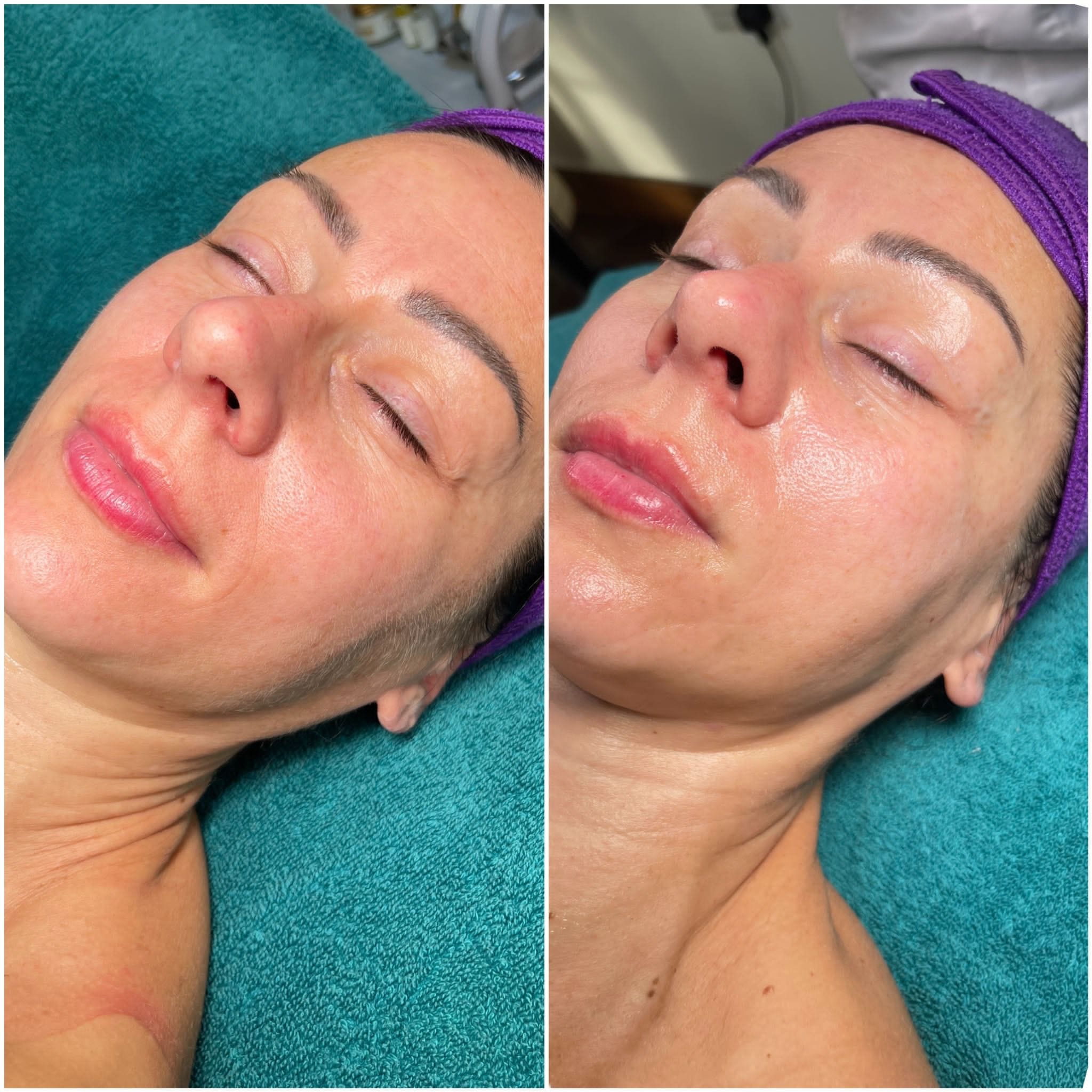 Dermaplaning results after 1
No facial hair
No more make up rolling !
Incredible Skin glow
Love love the results 🤩
#dermaplaning