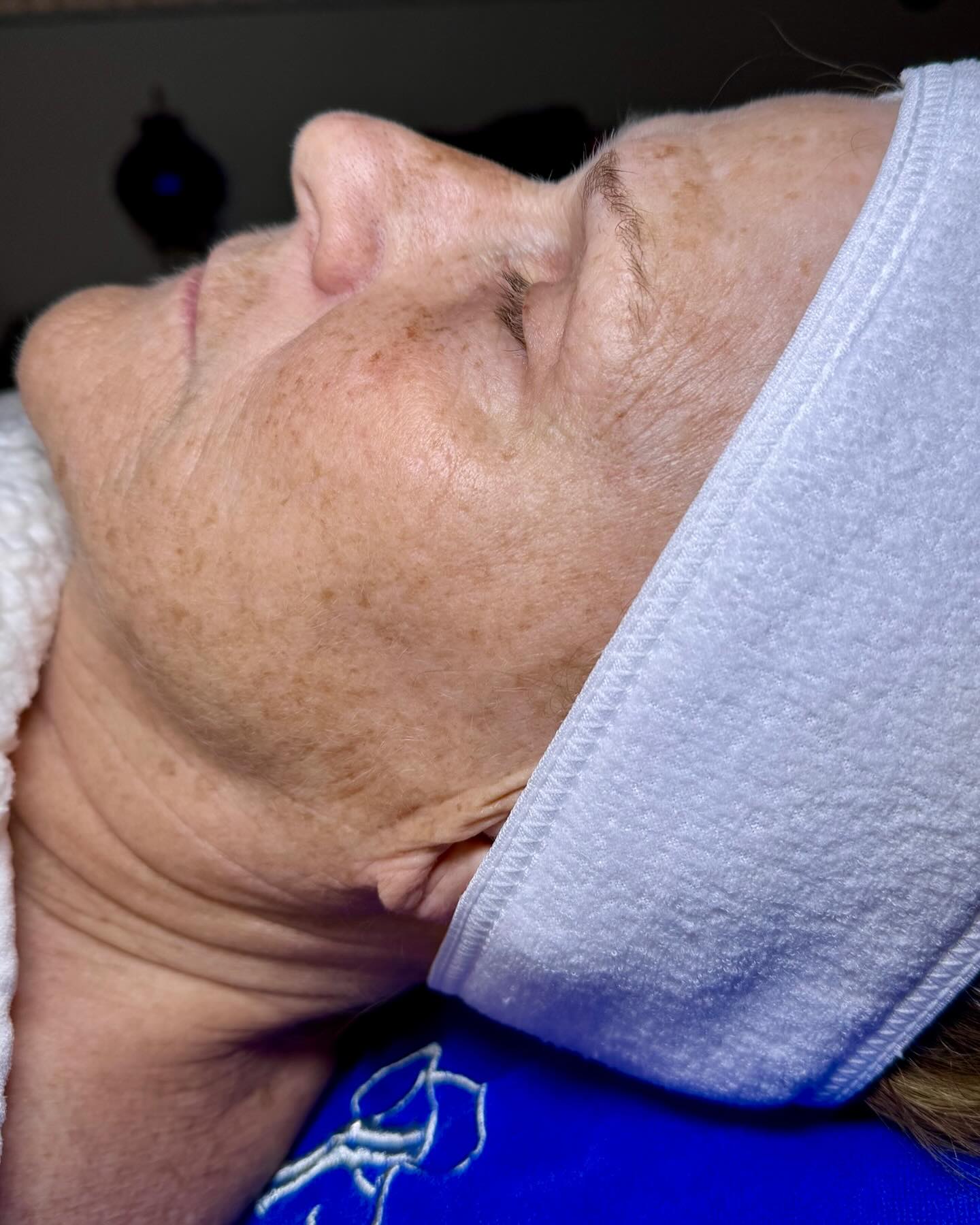 Lymphatic drainage Therapy delivered by #hydrafaci̇al is a fantastic relaxing noninvasive treatment to release unwanted puffiness and reveal a radiant glow.
#hydrafacial #hydranation#goodskin #selfcare #selflove
• Removes toxic buildup to reveal healthy looking skin
• Helps detoxify the skin
• Decreases inflammation
• Removes unwanted buildup
• Optimizes skin health