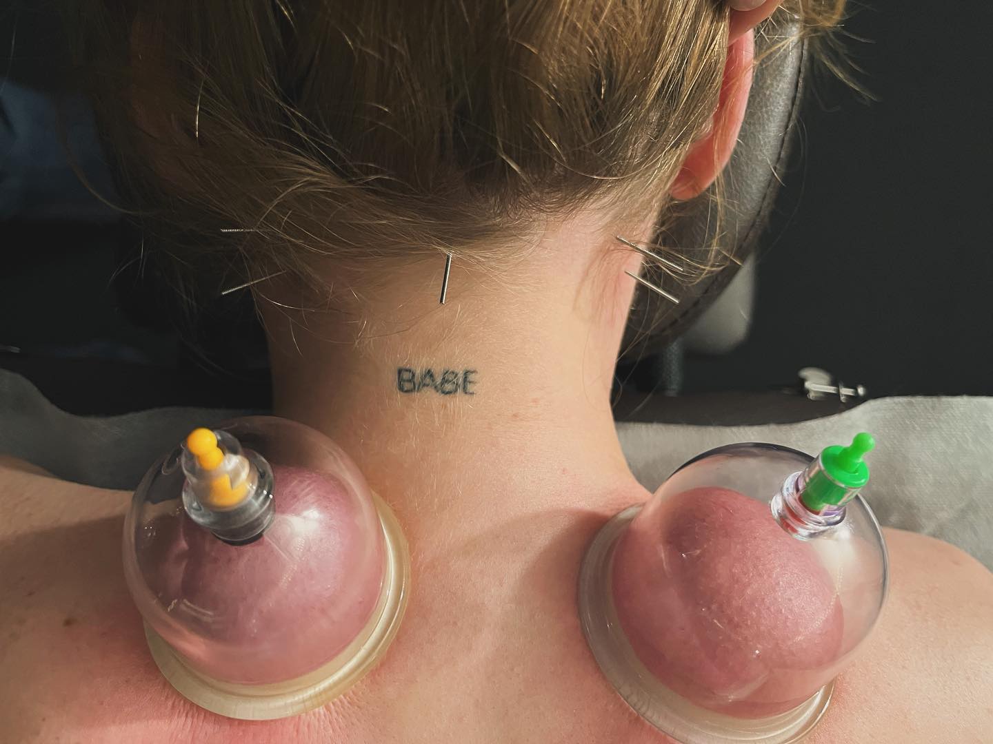 💅Hot girls goes to therapy!!👑 Akupunktūra stimuliuojami taškai galvos skausmui mažinti ir jūsų visų labai mėgstamos vakuuminės taurelės sumažinti nugaros įtampai🌀🌿