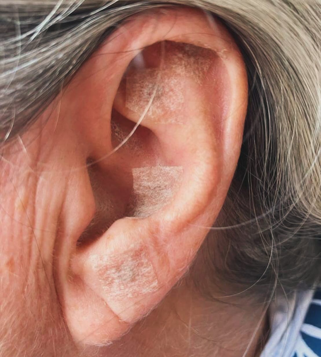 My secret weapon for effective pain relief and healing?? —> using the EAR in all of my treatments 👂🏼✨💪🏼
Just like in reflexology, which uses the feet to treat the different organs and parts of the body, auricular therapy or ear reflexology is a powerful and effective healing modality because of its close relationship with the brain.
It works by first finding reactive reflex points on the ear, which are then stimulated using either tiny needles or small seeds or magnets.
- Auricular therapy is used to treat numerous health conditions, detox the organs, reduce cravings and calm the nervous system. It’s most commonly used in weight loss and to quit smoking, but I’ve found it incredibly effective for pain, digestive issues, insomnia and a host of other problems. It’s also great for people who wish to avoid needles.
- There are over 200 points on the ears for every organ, bone, muscle, limb and part of the brain to points to reduce sensitivity to changes in the weather, combat depression, balance hormones and more.
- Pictured here, points for the nervous system and the muscles of the hand for a patient suffering from Dupuytren contracture (a condition where the skin on the palm thickens, pulling in the fingers and causing stiffness, spasms and pain).
- After only one session followed by ear seed placement, she felt significant relief and loosening up of the area, an effect that lasted over a week. The ear points stay in for 5-7 days, prolonging the effect of the treatment by providing continuous stimulation to their associated reflex points.
Want to find out if auricular therapy can help you? DM me for questions and more info 😉✍🏽
P.S. Massaging your ears (don’t forget to gently massage the the inside too) is like getting a whole body massage - it stimulates circulation and increases energy flow to your organs, promoting wellbeing and relaxation, and can provide relief from tension, aches and pain, and anxiety. Let me know how it goes :)
Love,
Teressa @joyfulheartacupuncture
#earacupuncture #auriculartherapy #acupuncturekohphangan #chinesemedicineworks #alternativehealth #healingkohphangan #acupuncturepoints #dupuytrentreatment