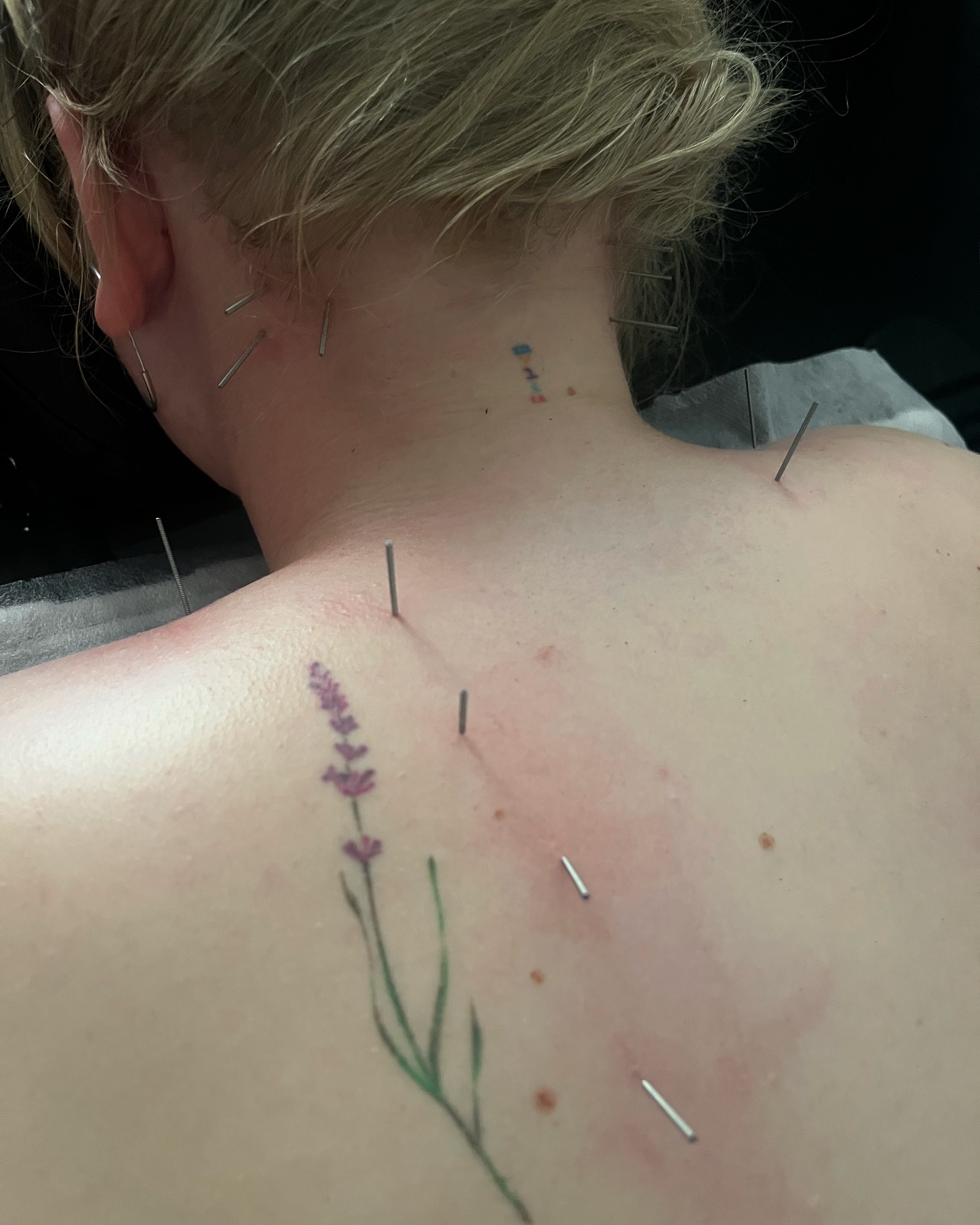 Akupunktūra su elektro stimuliacija.
Gydymas buvo atliekamas pečių juostai ir tarp menčių įtampai palengvinti.
Terapijos eiga: gydomasis masažas, akupunktūra su elektros stimuliacija ir vakuuminės taurės.
🌟🌟🌟