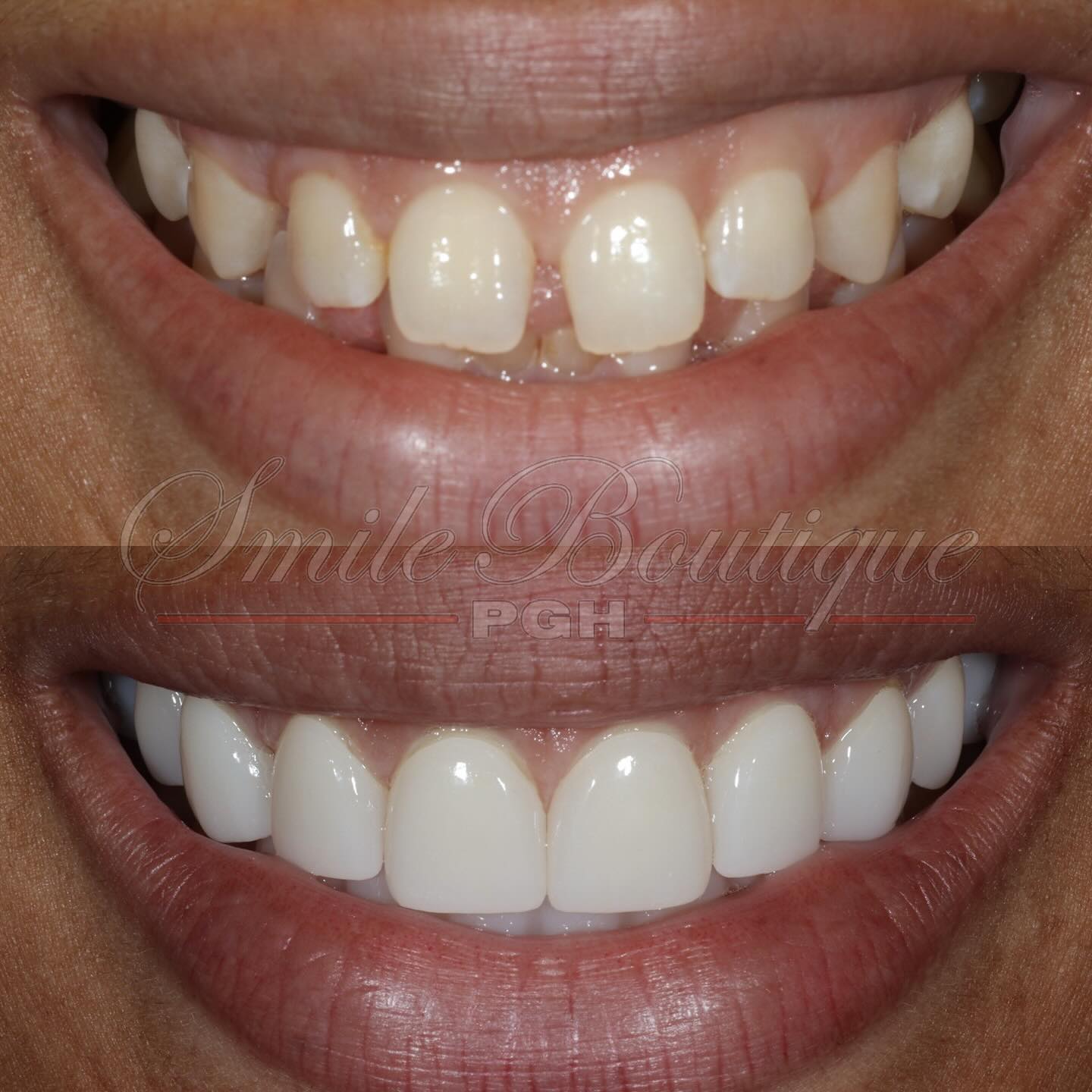 Monday Motivation 🤩
Featuring Ms. @youshmoney’s smile transformation 🙌
Her dislikes (✖️) & what we achieved (✔️):
✖️ Small teeth
✖️ Teeth sticking out
✖️ Uneven size teeth
✖️ Many gaps
✖️ Yellowed teeth
✖️ Crooked teeth
✔️ Balanced Smile
✔️ Brighter smile
✔️ Straighter teeth
✔️ Fuller smile
✔️ More teeth show
✔️ No more gaps
✔️ Better bite
Procedure prescribed:
1️⃣ Invisalign
2️⃣ Top - 12 units of Lithium Disilicate
3️⃣ Bottom - 6 units of Lithium Disilicate
Dominik wanted a bright full smile so I am thrilled that we’ve achieved that smile goal and she is now smiling with so much more confident happiness 🤩 Another happy smiling patient 🙏
To learn more on how to get your winning smile, schedule your consult with link in bio.
#winning #winningsmile #mondayvibes #mondaymotivation #mondaymood #newsmile #sopretty #justwow #soamazing #smilemore #confidentwomen #confidence #confidentlybeautiful #confidentsmile #smiletransformation #smilemakeover #teethwhitening #pittsburghdentist #cosmeticdentistry #cosmeticdentist #topdentist #aacd #happypatient #anotherone #anotherhappycustomer #luxurylifestyle #treatyoself #lifechanger #changinglives