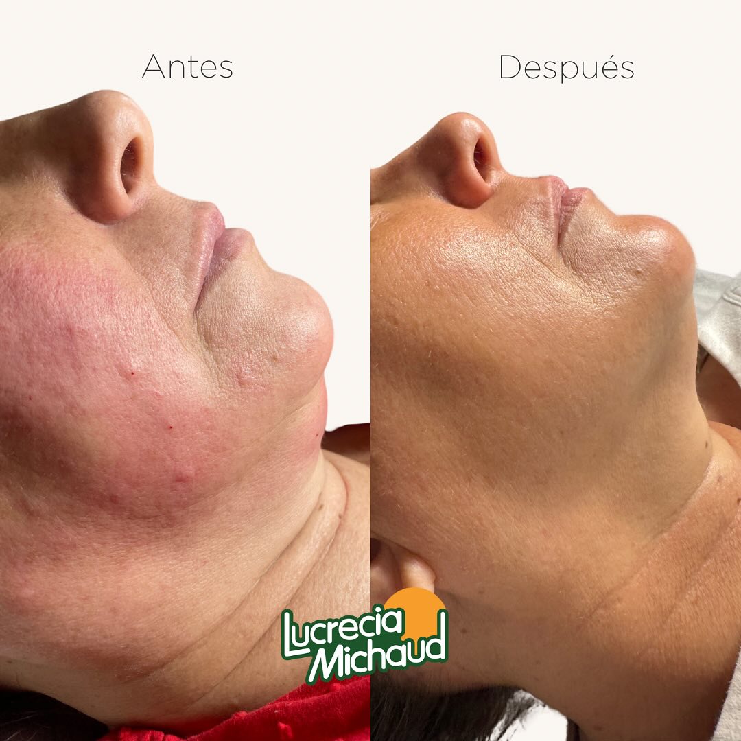 💆🏻♀️ HIFU + ULTRASONIDO CAVITACIÓN + MESOTERAPIA en la PAPADA 💉
En Lucrecia Michaud, combinamos HIFU, Ultrasonido Cavitación y Mesoterapia para reducir la papada en 1 mes.
1️⃣ HIFU: Utiliza ultrasonido para calentar las capas profundas de la piel, estimulando el colágeno, descomponiendo células grasas y tonificando los músculos faciales.
2️⃣ Ultrasonido Cavitación: Rompe las células grasas a nivel superficial, facilitando su eliminación natural.
3️⃣ Mesoterapia: Inyecciones de lipolíticos eliminan grasa localizada y mejoran la elasticidad de la piel con vitaminas.
Este tratamiento completo logra una reducción visible de la papada sin cirugía ni tiempo de recuperación. ¡Dale definición a tu rostro! ✨
#HIFU #cavitacion #mesoterapia #papada #lucreciamichaud #estetica #foryou #belleza #medicinaestetica #clinicaestetica #centroestetico #papadahifu