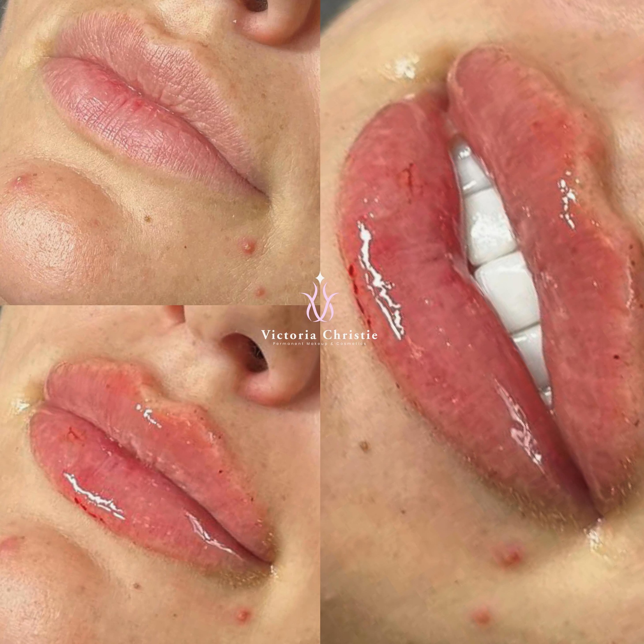 Aurora lips 💋
1ml lip filler
Lasts 12-18 months
£180 - 1ml
#lipfiller