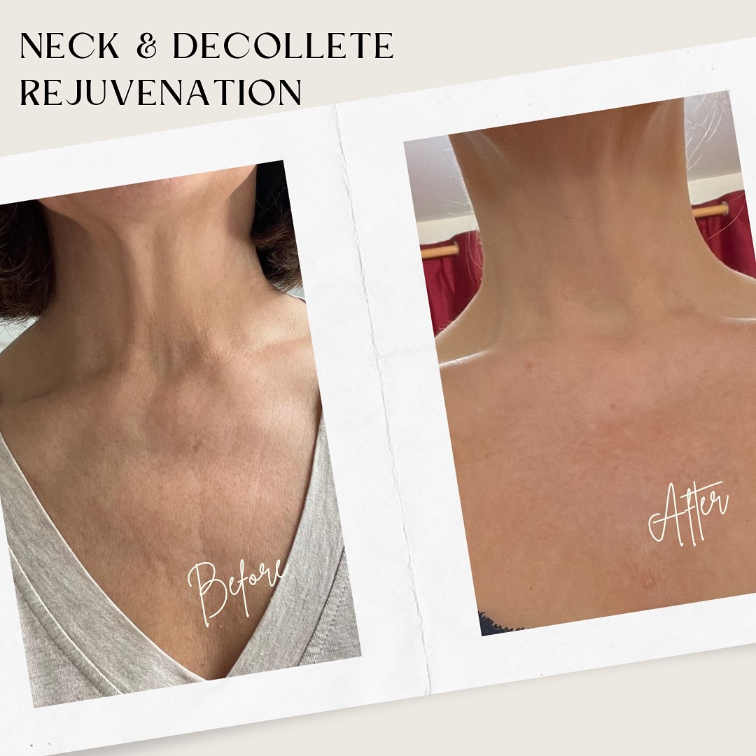 These results were too good not to share!!! 🤯
My beautiful client wanted to rejuvenate her skin on the neck and décolleté
To say she is thrilled is a complete understatement!😍
These areas along with the face and hands can be the age giveaways……🫣
After all age is just a number ✅
#skincare #selfcare #skinconfidence #ageinggracefully #beautiful #results #decollete #neck #rejuvenation #restore #treatment #youthful