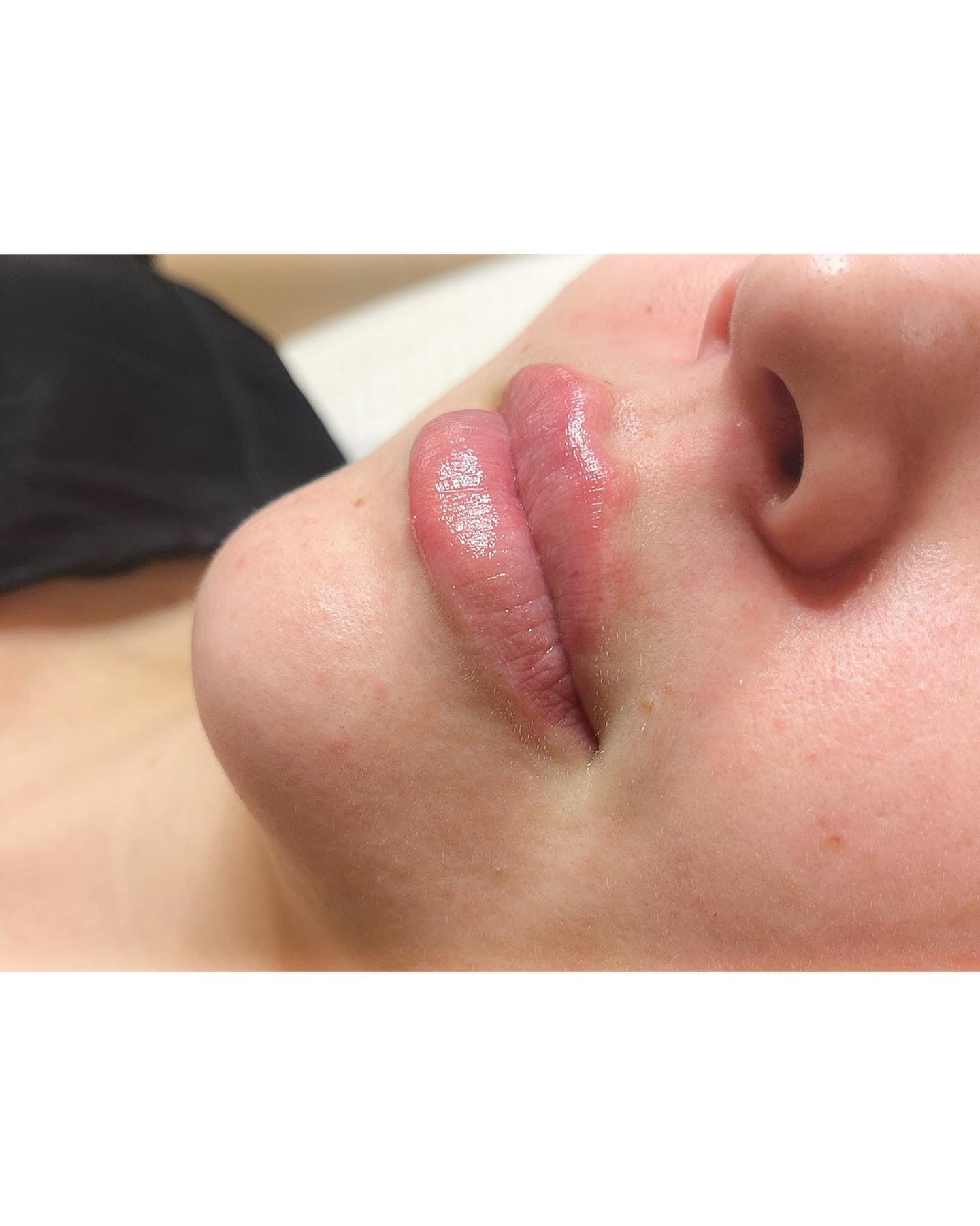 Hydratácia, zvýraznenie kontúr, dodanie objemu 🫦
~ aplikuje : lekár
~ 0,5 ml kyseliny hyalurónovej Teosyal
~ trvanie ošetrenia : 30 - 45 minút vrámci aplikácie anestetického krému
~ po ošetrení sa môžu objaviť modrinky a opuch, ktoré zvyknú ustáť po pár dňoch
By Dr. Bianca Strenáčiková
——
info@bianca.sk
+ 421 918 318 252
https://www.bianca.sk/