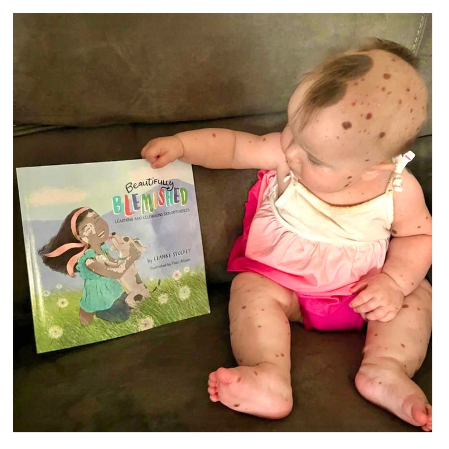 Adorable Miss Scottie already has such great taste in literature!🥰📚 This CMN beauty is just as cute as can be…don’t you agree!?😍
.
.
.
.
.
.
.
.
.
#nevus #cmn #beautifulbabygirl #birthmark #moles #childrensbook #diversity #inclusion #unique #diversebooks #visibledifference #beautymark #rareisbeautiful #birthmarkcommunity