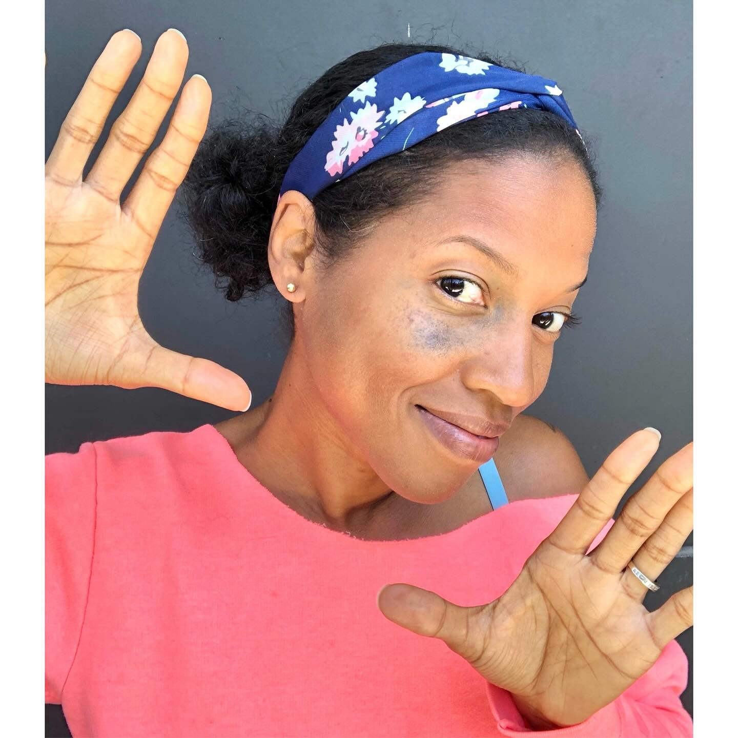 My face is a masterpiece because I was handcrafted by THEE greatest artist of ALL time!🥰🎨🙌✨—for I am fearfully & wonderfully made!…
I grew up wishing I could permanently coverup my birthmark so that people would stop staring, commenting and asking questions (I was/am an introvert and all the attention made me uncomfortable🫣) The journey to accepting and loving my birthmark has been a process, but I’m so grateful for the journey. I can now say that I feel blessed to be unique in this way.
This week is Face Equality Week and I love what @faceequalityint is doing to normalize and create equal opportunity for those who have a facial difference. You can join the #myfaceisamasterpiece campaign by visiting their page and helping to spread awareness.
Thank you for all you are doing!
.
.
.
.
.
.
.
.
.
.
.
.
#faceequalityweek #facialdifference #Godsthebestartist #birthmark #birthmarkawareness #nevus #createdbyGod #visibledifference #bodypositivity #beautifulAsIam #normalizefacialdifferences #birthmarkcommunity