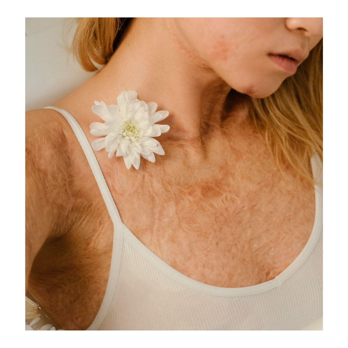 Charm is deceptive, and beauty does not last; but a woman who fears the Lord will be greatly praised.”
Proverbs 31:30
—“I am beautifully blemished”
#beauty #charm #perspective #feartheLord #truebeauty #worth #value #purpose #scars #keloid #visibledifference #burnsurviver #beautifullyblemished