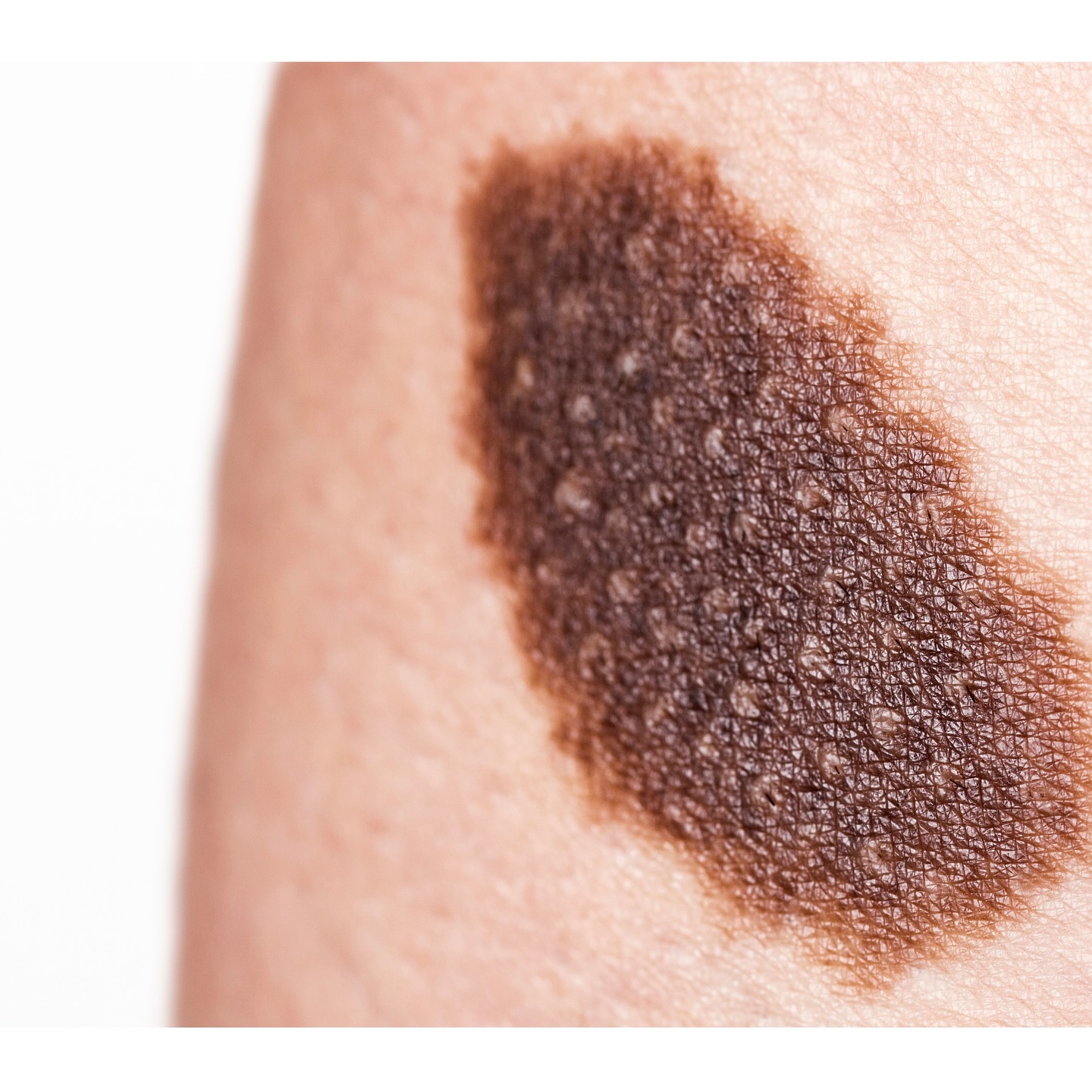 #DidYouKnow — CMN can be light brown to black patches or plaques. It can present in variable ways, and cover nearly any size surface area or any part of the body. The incidence of CMN seems to be independent of skin color or other ethnic factors.
Small to medium CMN are predicted to occur in more than one in a hundred births. Large and especially giant CMN, exceeding a predicted diameter at adult age of at least 20 cm on the body, form a much rarer subset, with prevalence estimated at around 1 in 50,000 births. —raredisease.org
.
.
.
.
.
.
.
.
.
.
.
#birthmarks #cmn #nevus #moles #spots #visibledifference #skindifferent #birthmarkcommunity #beautifullyblemished