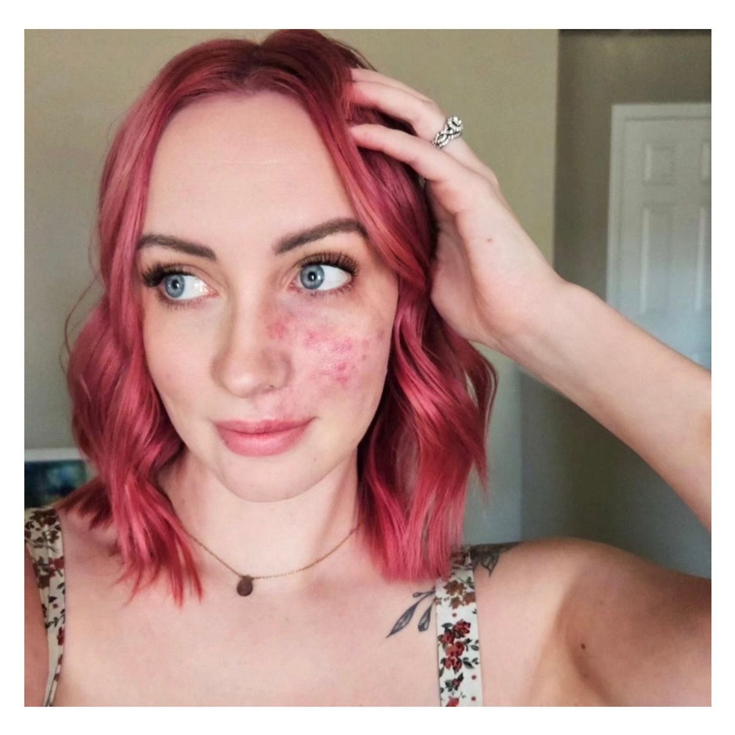 Praying for a smooth treatment day and a quick recovery for our birthmark sis, Rachel.🙏💞—
・・・
“Tomorrow is my birthmark treatment day. It’s been almost 2 years since my last one. Let’s just say a laser going deep into your face is very uncomfortable to say the least. 🤣😬 And I never look forward to the 2 week recovery...
⠀⠀⠀⠀⠀⠀⠀⠀⠀
But I’m looking forward to keeping it healthy and preventing it from growing or causing too many issues in the future ❤️
Cheers 🍻 to matching my hair to my birthmark this week and to embracing what makes us unique✌️”
.
.
.
.
.
.
.
.
.
.
#pws #treatmentday #lasertreatment #visibledifference #birthmark #spots #recovery #BBfamily