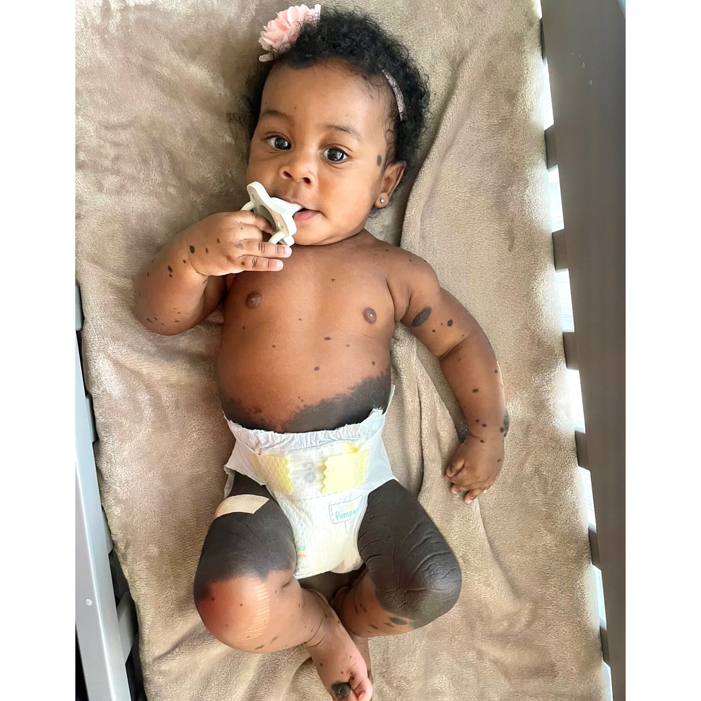 Adorable Miss Caylee has the #spotlight today. Caylee is 6 months old and has Congenital Melanocytic Nevi (CMN). Show this cutie some love!❤️
⠀⠀⠀⠀⠀⠀⠀⠀⠀
Congenital Melanocytic Nevi (CMN): A skin lesion that’s present at birth or develops shortly after. They are benign growths that are made up of abnormal collections of melanocytes, or pigment-forming cells.
**thank you, Chelsea, for sharing.💞
.
.
.
.
.
.
.
.
.
#cmn #cutiepatootie #birthmarkbaby #visibledifference #differentisbeautiful #beautifulAsIam #birthmarkbeauty #birthmark #birthmarkcommunity #beautifullyblemished #BBfamily