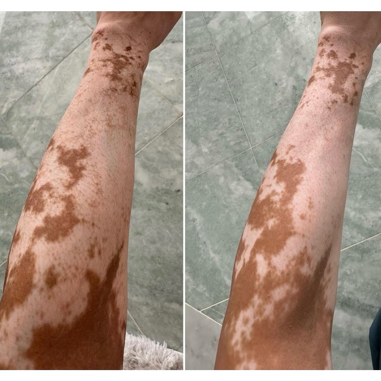 Thank you for being transparent about this part of your journey @jennyweaverworships —
・・・
“Might not mean anything to you but I jumped up for joy and started shouting today when I was In my prayer room I noticed my arm is rapidly gaining color back!! It’s a prophetic sign to me
“The time will come when God will restore everything” Acts 3:21 😭😭😭😭😭 “
.
.
.
.
.
.
.
.
#vitiligo #journey #repigmentation #vitiligocommunity #spots #Jesus #healer #promisekeeper #beautifullyblemished