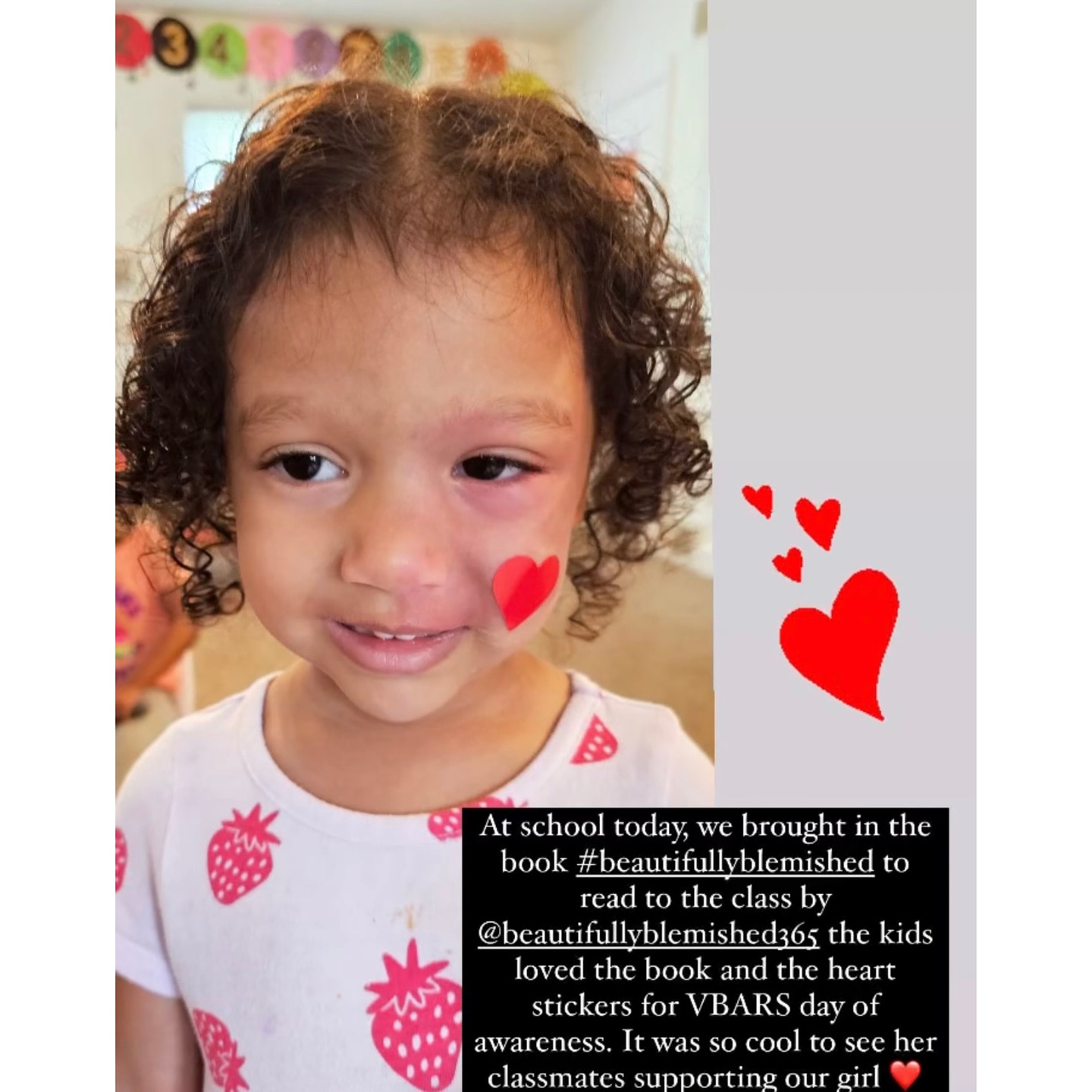 Heart melted🥰…messages like these will forever be fuel to our fire!
⠀⠀⠀⠀⠀⠀⠀⠀⠀
So glad you felt loved and supported in this way, sweet Etta Rose, you deserve it.😘
.
.
.
.
.
.
.
.
.
.
.
.
.
#advocate #educate #awareness #support #childrensbooks #booksforkids #diversebooks #inclusivebooks #skindifferent #visibledifference #birthmark #vitiligo #portwinestain #keloid #moles #scars #rosecea #psoriasis #nevus #hemangioma #eczema #diversity #inclusion #selflove #selfconfidence #loveyourskin #normalizebirthmarks #birthmarkawareness #birthmarkcommunity #beautifullyblemishedbook