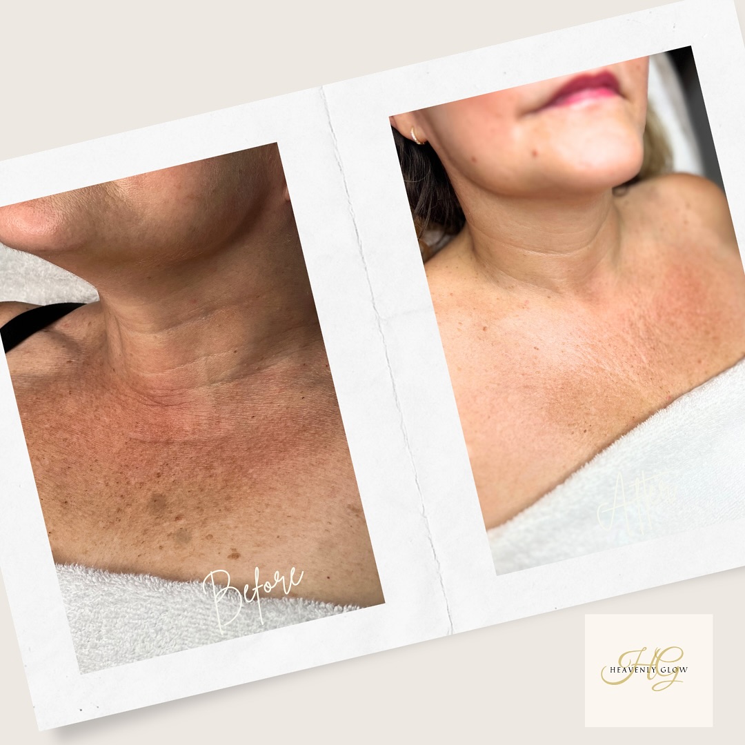 The neck along with the hands and face are the tell tale signs of ageing 🤍
This improvement was made for this beauty with 3 sessions of microneedling using a powerful mesotherapy cocktail to rejuvenate the skin 🥰
#skincare #neck #mesotherapy #rejuvenation #ageing #replenish #selfcare #beauty