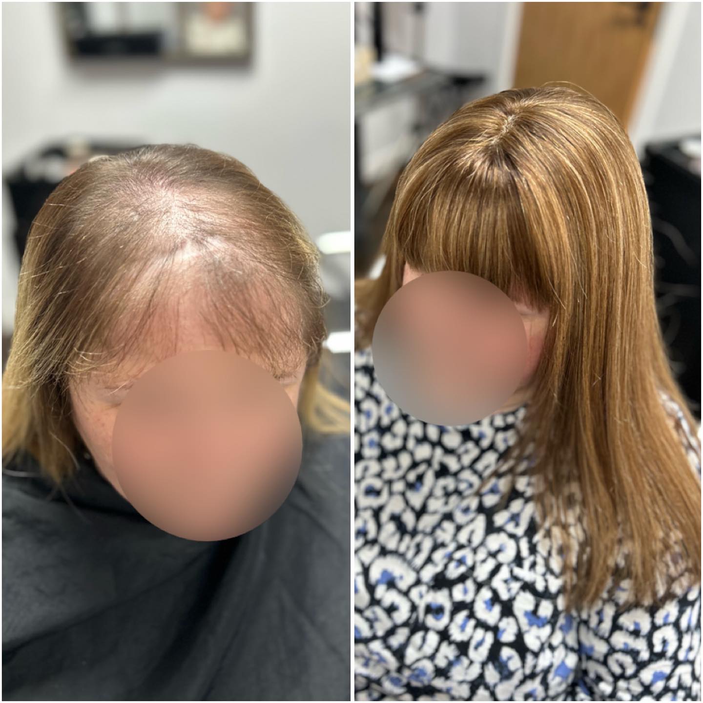 I had the pleasure of building this young lady a system last week.
She had an accident years ago which left her with scarring.
She can now wear her system permanently and treat it like her own hair. ❤️.
.
.
.
.
#lacetopwigs #lacefrontwigs #lacewigs #wigs #lacefrontal #alopecia #areata #hairloss #hairreplacements #bespokewigs #customcolouredwigs #handmadewigs #wigbuilding #hairintegration #laceintegration #hairextensions #weave #hairlossspecialist #trichologist #trichology #hairlosssolution #hairlosssalon #hair