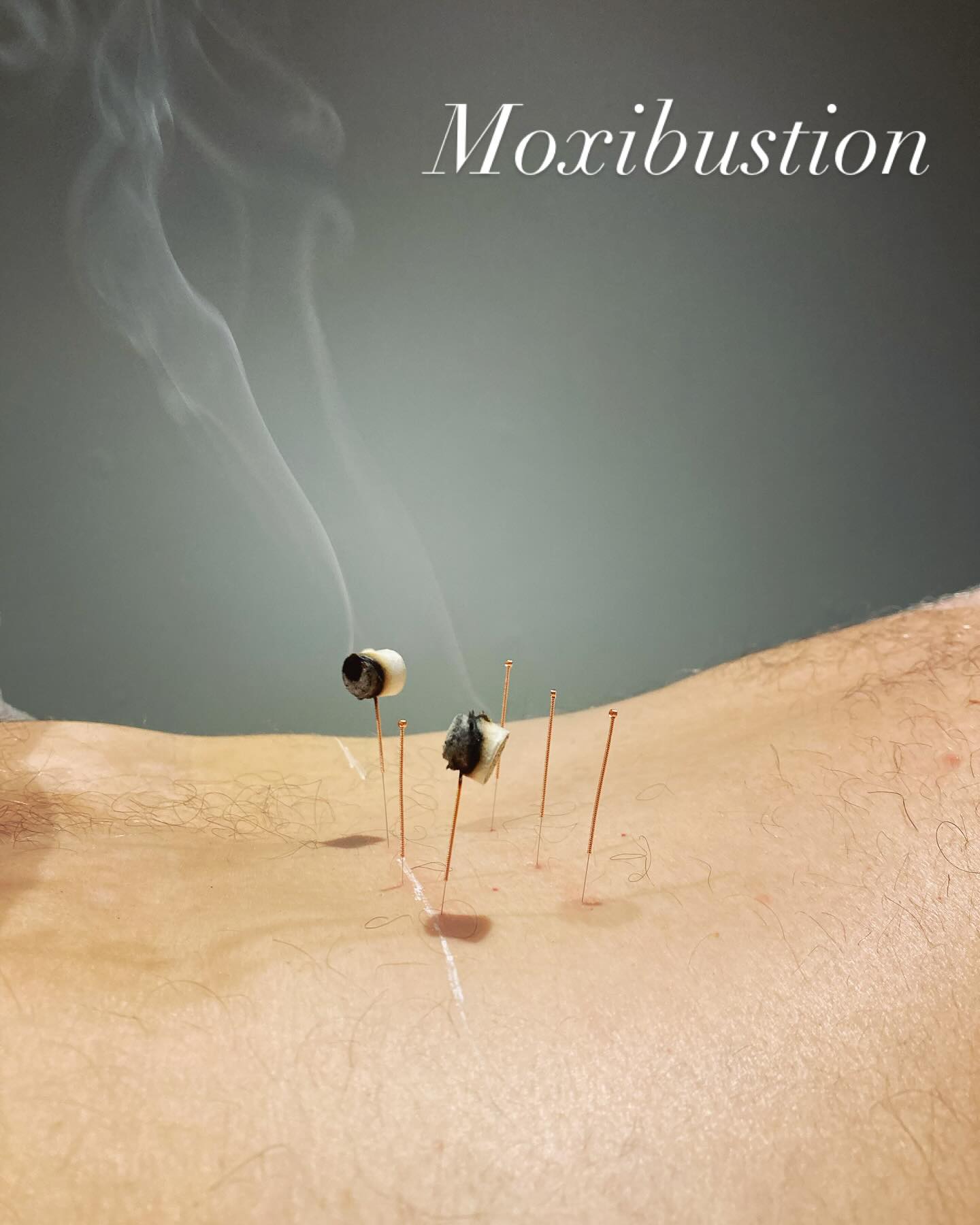 What is Moxibustion? Moxibustion is an essential part of Chinese medicine which takes its name from moxa, a natural substance prepared from mugwort leaves.
Moxa can be held just above the skin, placed on top of an acupuncture needle or directly on the skin, usually over specific acupuncture points or meridians. The herb is then lit and as it slowly smoulders, heat permeates the skin and affects the flow of ‘qi’ (energy) and blood in the area being treated.
Needle moxa (as shown in this photo) is a perfect way of treating MSK (musculoskeletal) conditions such as lower back pain, sciatica and knee pain. The warmth of the moxa permeates into the needle and patients report a deep warmth and release in the affected area. It’s a personal fave of mine, especially when I can watch the beautiful smoke spiral upward. #moxibustion #fiveelementacupuncture #needlemoxa #acupuncture #wymondham #norwichacupuncture