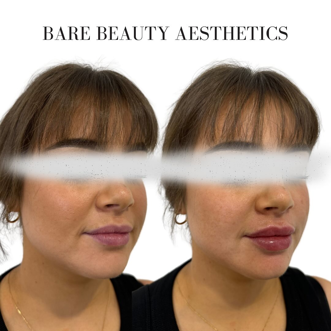 Lip Augmentation with Registered Nurse Hayley 💉👄
Plumpness and hydration CHECK ✅
Please Note: Post procedure swelling present in after photo. Photos shared with clients consent 💕
.
.
.
.
.
.
.
.
.
.
.
.
#lipfiller #lipfillerbeforeandafter #beauty #confidence #fyp #ilovetaupo #cosmeticinjector #cosmeticnurse #registerednurses #dermalfiller