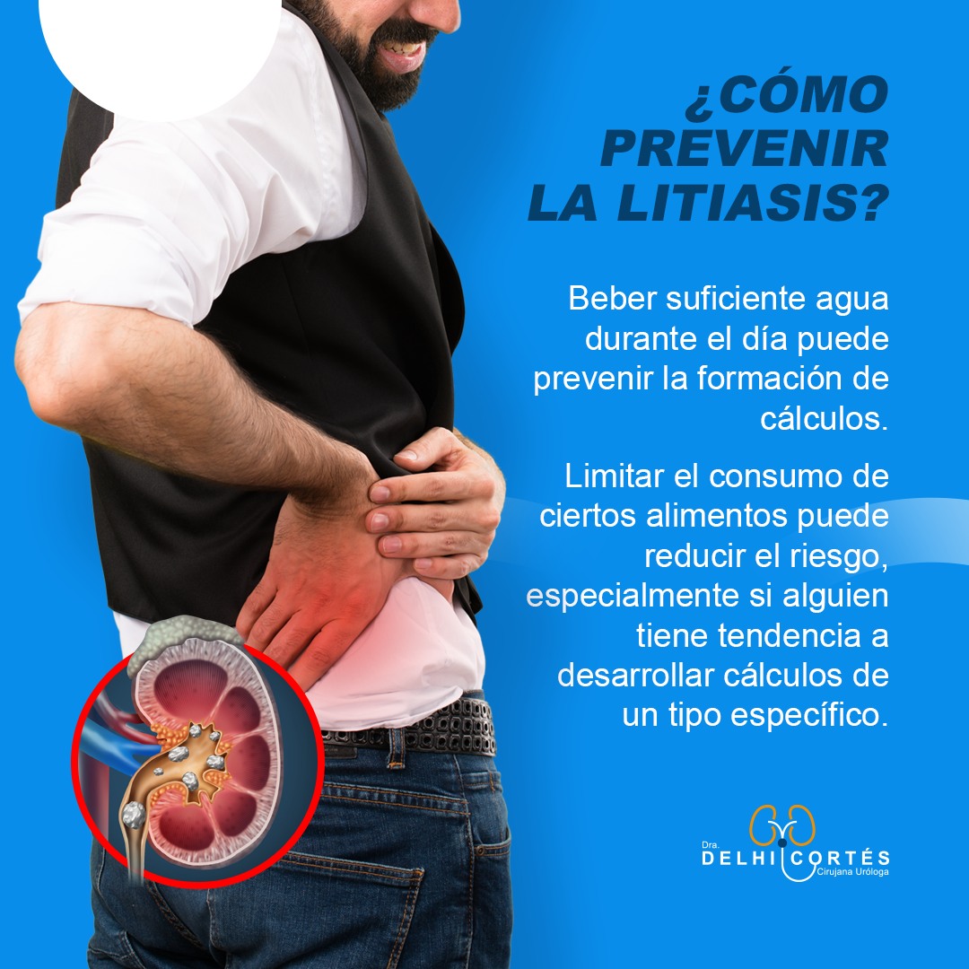 🙌La litiasis es el término médico utilizado para describir la formación de cálculos o piedras en el cuerpo, generalmente en los riñones o en las vías urinarias.
👉Estos cálculos pueden variar en tamaño desde partículas microscópicas hasta piedras grandes del tamaño de una nuez.
✅Es fundamental buscar atención médica, el tratamiento oportuno y los cambios en el estilo de vida pueden ayudar a prevenir la recurrencia y las complicaciones asociadas con esta condición.
Agenda tu cita 👇
⚕️Doctoralia: https://www.doctoralia.com.mx/yeniseik-delhi-cortes-vazquez/urologo/san-andres-cholula
📞 Teléfono: 222 227 2713
✅ WhatsApp: 561 213 3757
Dirección:
📍 Periférico Ecológico 3507, int. 1229, Col. Emiliano Zapata, San Andrés Cholula
Horarios:
🕗Martes y jueves de 16:00 a 20:00 hrs
🕗Sábados de 10:00 a 14:00 hrs
👩⚕️ Dra. Delhi Cortés
Médico general, C.P. 09137489
Especialidad en urología, C.P. 12342044
Certificación del consejo Mexicano de Urología, 1787
#urología #urologo #médicourologo #urologa #urologocholula #urologacholula #médicocholula #urologoTlaxcala #Puebla #Tlaxcala #Cholula