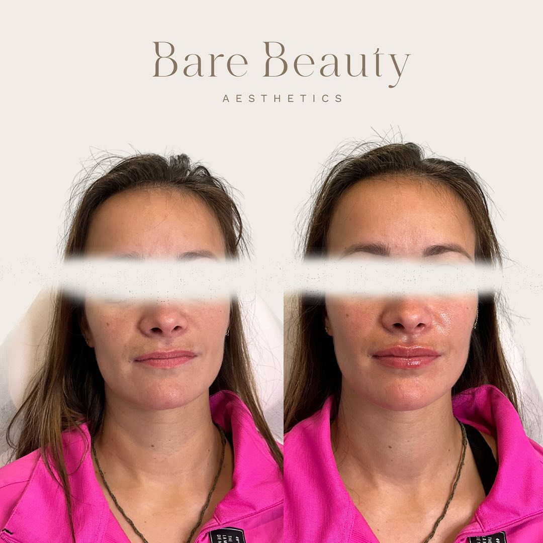 When I say natural results… I mean NATURAL RESULTS 💕
Little sprinkle of dermal filler in both cheek and lip area. Total used was only 1.8ml! 1ml cheeks and 0.8ml in lips 💋
Before and after shared with clients consent.
If you’ve been thinking about getting any injectable treatments, please feel free to book in a complimentary consultation (booking link in bio) or you’re more than welcome to flick me a private message where I will get back to you as soon as possible 😊
#cosmeticinjector #registerednurse #beauty #confidence #dermalfillers #lipfiller #ilovetaupo #taupo #antiwrinkle