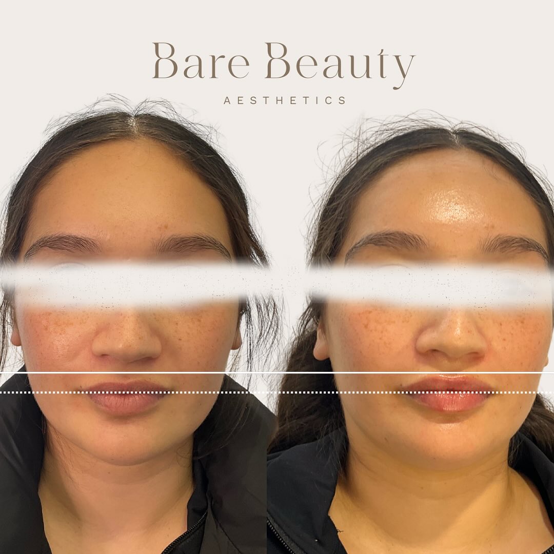 ✨Natural Lip Enhancment✨
This beautiful client came in wanting to add a little bit more vertical height to her top lip to match her bottom lip 💋💉
Dermal filler can be a scary topic for many (thanks social media🙃) HOWEVER, please know that there are many injectors out there that believe a more “natural” approach is best.
I am a very firm believer that when it comes to injectables, we want people to look at you and notice that you’re looking amazing …. But not thinking it’s because of getting injectables 😂 By putting the right amount of dermal filler in the right place, it can look completely natural. This is the core reason why I named my business Bare Beauty Aesthetics.
Please Note: After photo shared with clients consent. Minimal swelling present in after photo.
Dermal Filler, Medical Device Class III to smooth facial wrinkles and folds, correct facial atrophic scars, restore or enhance the lips, or restore facial volume. Dermal filler has risk and benefits. Ask your doctor if dermal filler is right for you. For product information, check with your doctor or from product details with the supplier.
#cosmetics #cosmetinjectable #cosmeticnurse #aesthetics #aestheticnurse #antiaging #beauty #filler #injections #dermalfillers #neuromodulators #skincare #wrinkles #finelines #antiwrinkle #facialesthetics #ilovetaupo #womenempowerment #selfcare #booknow #consultation #linkinbio #lipfiller