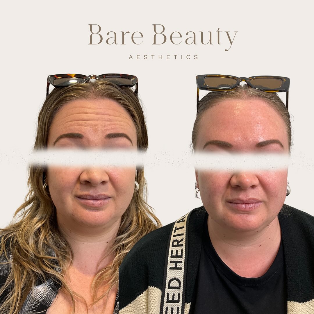 Anti-wrinkle Magic 🪄🤯😍
Check out this gorgeous transformation! My beautiful client came in for her first anti-wrinkle treatment to target those forehead lines and frown lines, and the results are incredible! See how smooth and refreshed her skin looks?
Anti-wrinkle works by temporarily relaxing the muscles that are causing fine lines/ wrinkles in the skin when the muscles contract. When the muscle is relaxed, this then can help reduce the appearance of those unwanted lines giving a more youthful and “less-tired” look.
Please note: “After” photo was taken 2weeks post initial treatment.
Photo 1: Client is raising eyebrows in both before and after
Photo 2: Client is frowning in both before and after
If you’re interested in learning more about Cosmetic Injectables and how they can potentially help achieve your aesthetic goals, please send me a DM or alternatively you can book a complimentary consultation (link in bio) where we can work together and create an individualised treatment plan 💕
📍Located Taupo
#cosmetics #cosmetinjectable #cosmeticnurse #aesthetics #aestheticnurse #antiaging #beauty #filler #injections #dermalfillers #neuromodulators #skincare #wrinkles #finelines #antiwrinkle #laketaupo #facialesthetics #ilovetaupo #womenempowerment #selfcare #booknow #consultation #linkinbio