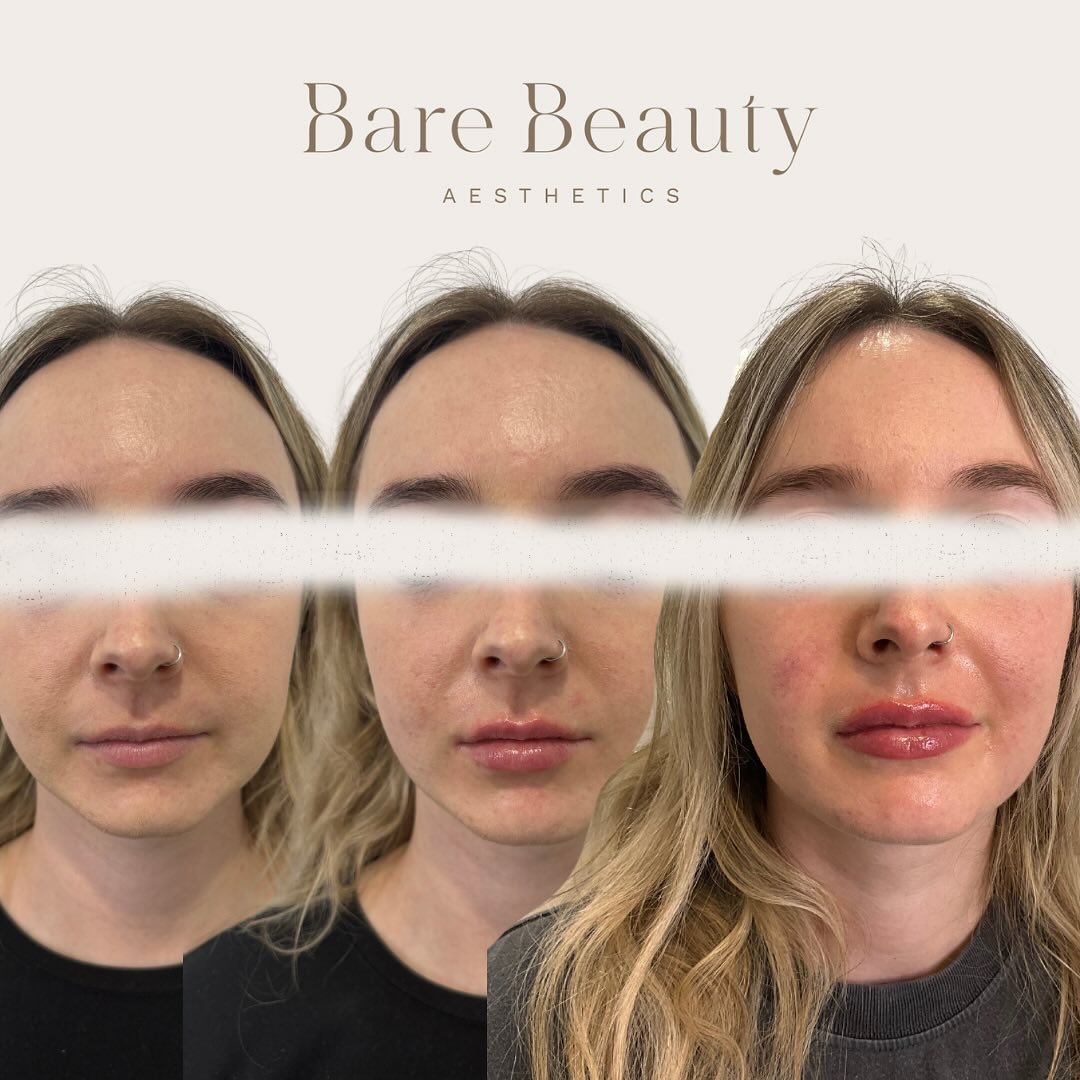 LIP FILLER JOURNEY 💉👄
Did you know lip filler…
💉Can help hydrate your lips
💉Can look natural!
💉Can be a journey process!
Lips shouldn’t be a rushed treatment (especially if you have slightly smaller lips to start with.) In order to get the most aesthetically pleasing results, it’s best we do not rush the process and take it one step at a time. The best way to find out what your injectables journey may look like is to book a consultation so that your injector can see and assess your face holistically and create an individualised treatment plan.
Photo one: In this photo, the before photo on the left shows the client with no lip filler at all. The middle photo shows client directly after first treatment with 0.5ml added (slight swelling present.) Photo on the right shows client six weeks after initial treatment with 0.6ml added (slight swelling present.)
It is very common for first-time lip filler clients to start off with a small amount because of the thought of not wanting to look “over-done” or “un-natural” ( thanks social media 😒😂.) This is why it’s important that you have these discussions with your injector and you find someone you can trust and that shares similar aesthetic goals and values as you.
Photo two: side profile before photo on left and after photo on the right (slight swelling present)
If you’ve been thinking about getting any injectable treatments, please feel free to book in a complimentary consultation (booking link in bio) or you’re more than welcome to flick me a private message where I will get back to you as soon as possible 😊