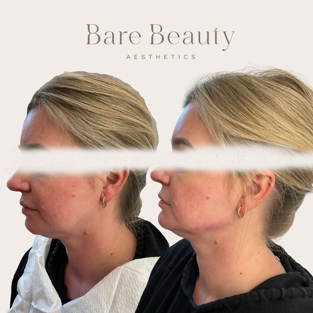 ✨THE POWER OF JAW ENHANCEMENT ✨
Over time, it’s natural for our skin to lose collagen and for facial fat pads to shrink. This can cause a loss of volume in key areas, making the face look less defined. Treatments can address this volume loss, helping to restore the youthful contours of your face for a refreshed appearance.
If you’re interested in learning more about Cosmetic Injectables and how they can potentially help you, please send me a DM or alternatively you can book a complimentary consultation with me (link in bio) where we will work together and create an individualised treatment plan 💕
Please Note: After photo taken directly after treatment. Photos shared with clients consent.
📍Located Taupo
#jawfiller #dermalfiller #antiaging #facialcontouring #volumeloss #jawline #aesthetics #beauty #nonsurgical #injector #fillers #injectables #cosmetics #transformation #beforeandafter #confidence #cosmetics #cosmeticnurse #aesthetics #aestheticnurse #antiaging #beauty #dermalfillers #skincare #wrinkles #finelines #antiwrinkle #facialesthetics #ilovetaupo #womenempowerment