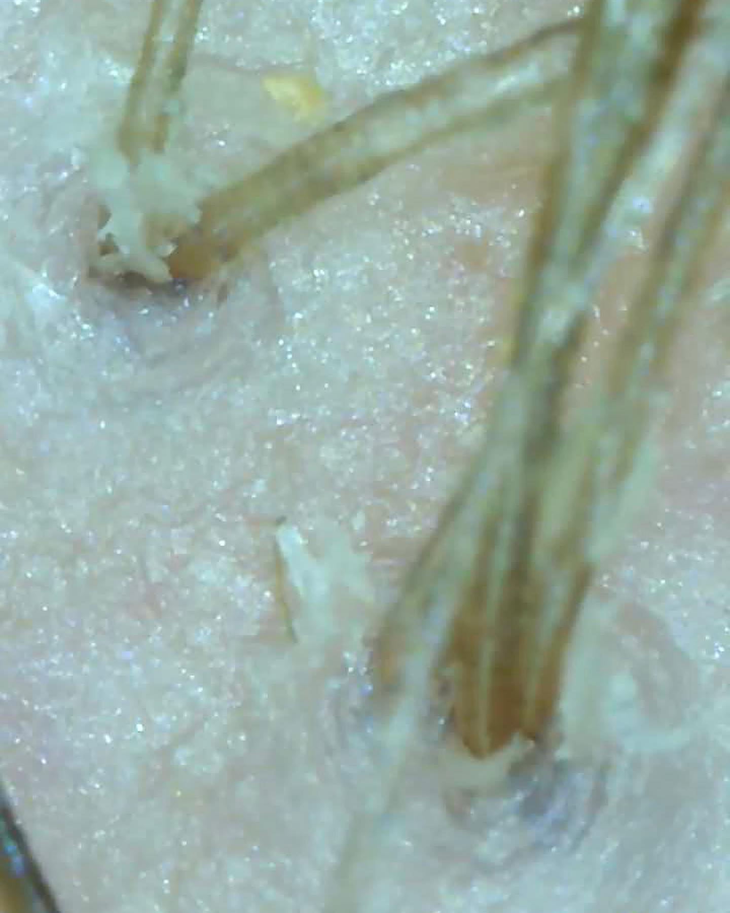 A trichoscope is a specialised tool used for examining the hair & scalp in detail. It provides a magnified view allowing for a more thorough assessment. Trichoscopy can help identify issues such as hair thinning, hair loss, scalp conditions, and other abnormalities. It can also be used to monitor the progress of treatment for hair and scalp conditions. Trichoscopy is a valuable tool for consultations to help build a bigger picture. Above is a picture I recently took of a lady’s scalp, we can see her scalp looks lovely and healthy and she has multiple hairs exiting out each follicle which is good and what we want. Closer to the front hairline (the next pictures)we can see the start of miniaturisation, the process in which hair follicles become smaller and produce thinner, shorter, and lighter hairs. This phenomenon is commonly seen in conditions such as androgenetic alopecia (male or female pattern hair loss), where hair follicles shrink over time due to genetic and hormonal factors. As a result, the hair growth cycle is disrupted, leading to the production of progressively finer and shorter hairs. .
.
.
.
#lacetopwigs #lacefrontwigs #lacewigs #wigs #lacefrontal #alopecia #areata #hairloss #hairreplacements #bespokewigs #customcolouredwigs #handmadewigs #wigbuilding #hairintegration #laceintegration #hairextensions #weave #hairlossspecialist #trichologist #trichology #hairlosssolution #hairlosssalon #hair