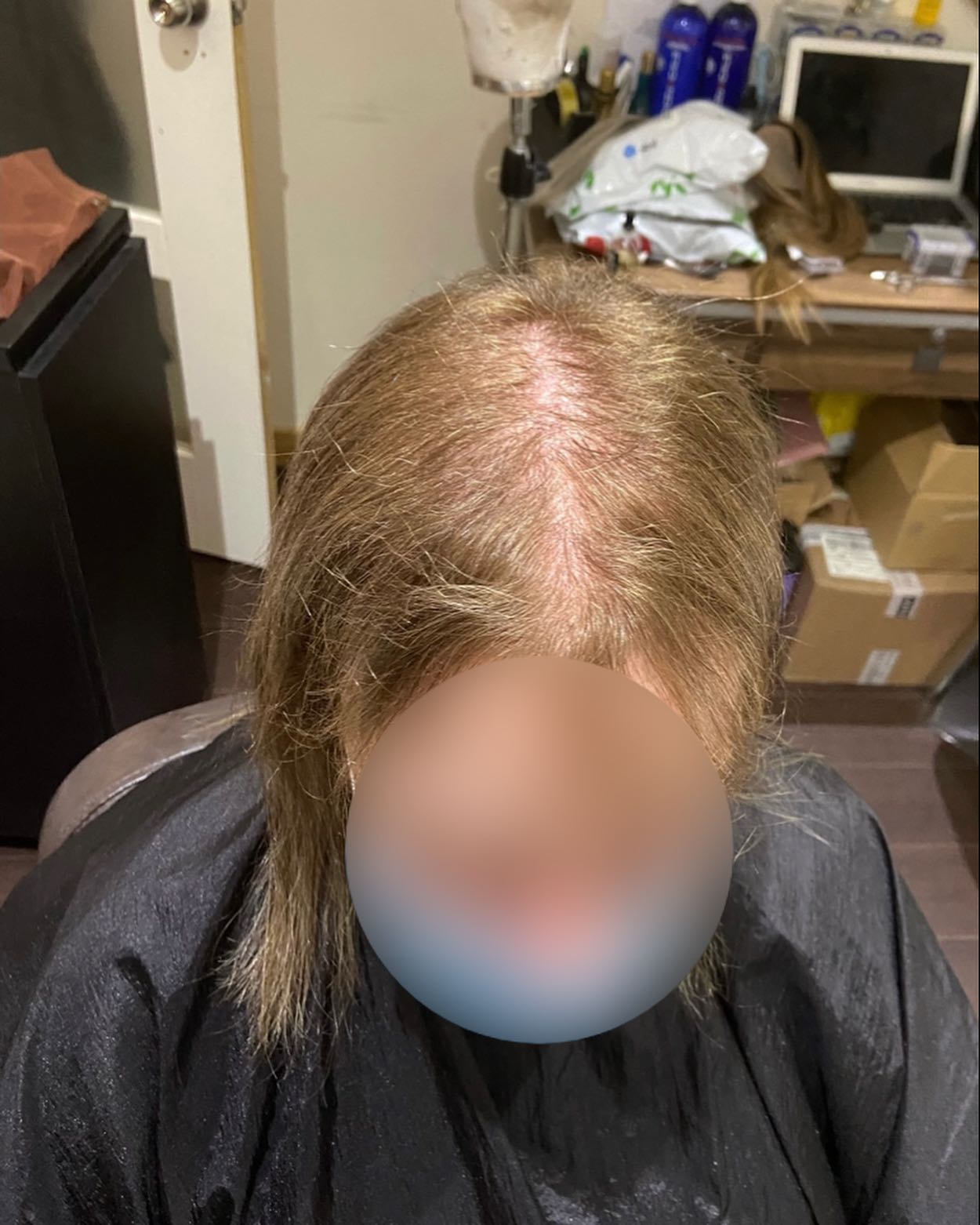 SWIPE ➡️ FOR PROGRESS 🌟 Transformation Alert! 🌟 This incredible lady underwent gastric surgery 5 years ago, and while it posed some challenges, including hair loss due to nutrient deficiencies, her journey is nothing short of inspiring! Just look at her progress photos—her hair is looking fuller and healthier than ever! 💁♀️✨
Today, we refitted her system to support her ongoing recovery. But the big question is: will she need it for much longer? 🤔
Share your thoughts and experiences below! Have you faced similar challenges? Let’s support each other! 💬❤️
#HairCareJourney #WellnessWarrior #TransformationTuesday