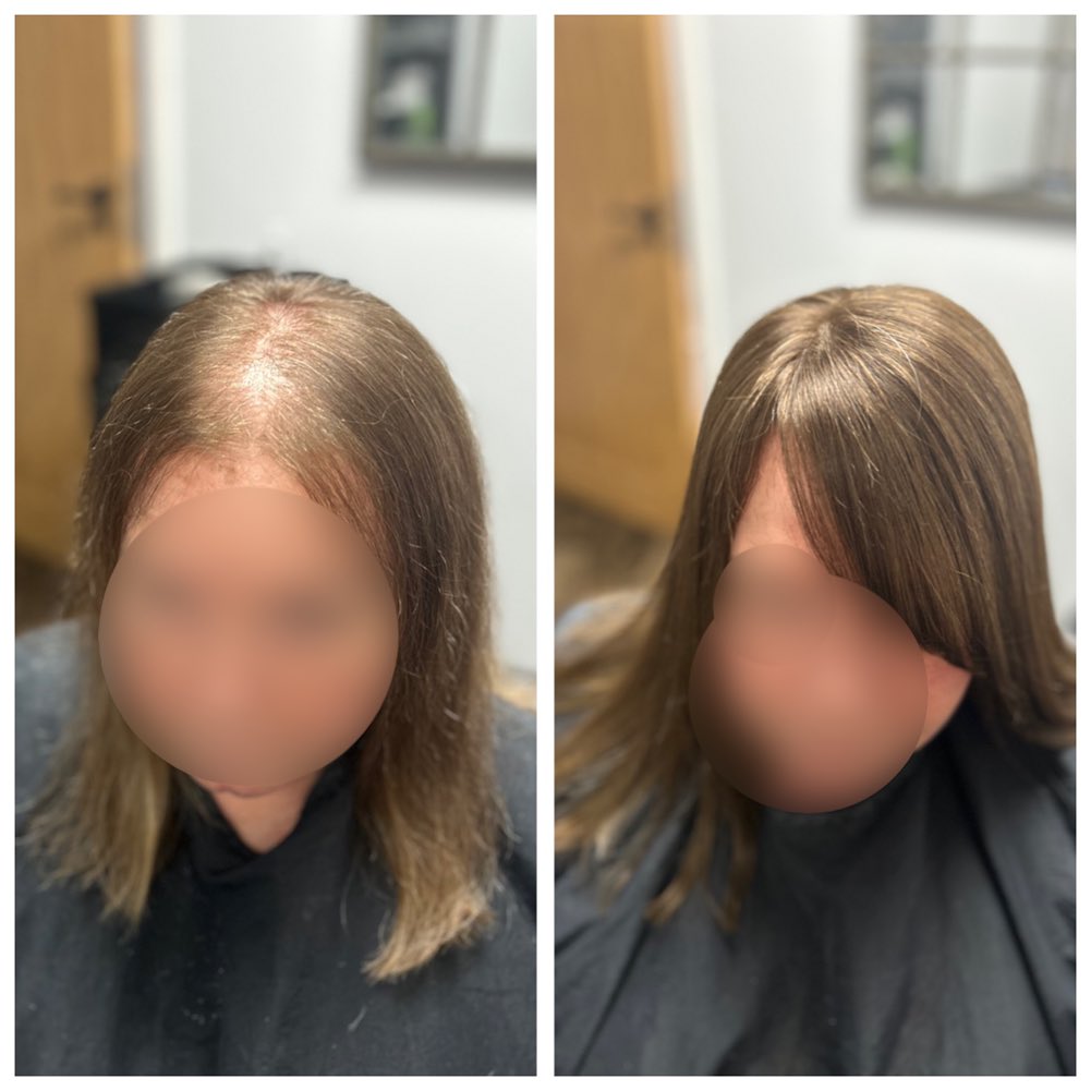 My job so rewarding. Helping people feel confident and beautiful is truly a privilege ❤️Today I had this lovely lady in my chair. After 2 and a half years it was time for a new lace integration system. I’ll see her again in a month for her maintenance appointment..
.
.
.
.
.
.
#lacetopwigs #lacefrontwigs #lacewigs #wigs #lacefrontal #alopecia #areata #hairloss #hairreplacements #bespokewigs #customcolouredwigs #handmadewigs #wigbuilding #hairintegration #laceintegration #hairextensions #weave #hairlossspecialist #trichologist #trichology #hairlosssolution #hairlosssalon #hair #covidhair #covidhairloss