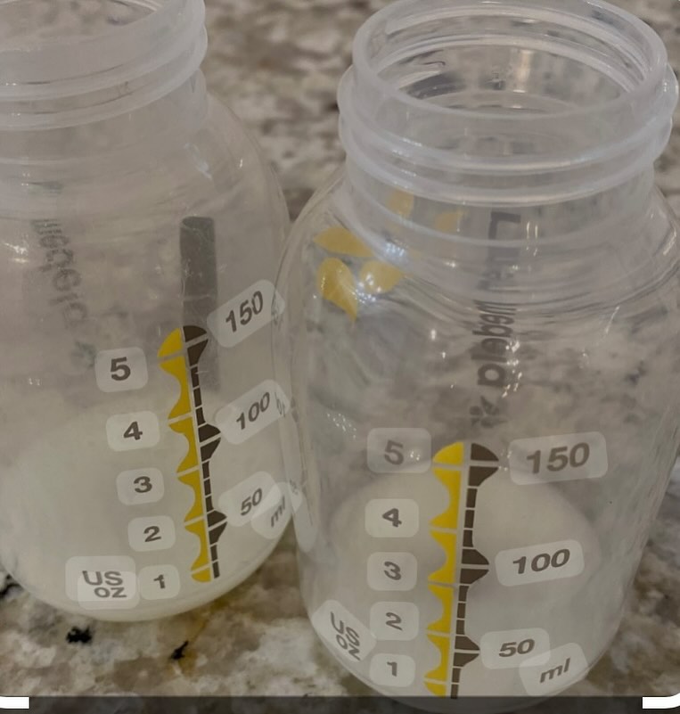 Why Do Some Women Experience Low Milk Supply While Breastfeeding?
Breastfeeding is a natural process, but it doesn’t always come easily for everyone. One common challenge new mothers face is a low milk supply. Here are a few key reasons why this might happen:
1. Hormonal Imbalances: Conditions such as polycystic ovary syndrome (PCOS), thyroid disorders, or diabetes can interfere with the hormonal balance needed to produce milk.
2. Improper Latch: If the baby isn’t latching correctly, they may not be stimulating the breasts enough to trigger milk production. This can lead to less frequent milk removal, signaling the body to produce less.
3. Infrequent Nursing or Pumping: Breastfeeding works on a supply-and-demand basis. If milk isn’t removed frequently, the body will produce less. Skipping feedings or supplementing with formula too early can reduce the body’s natural milk production.
4. Stress & Fatigue: Physical and emotional stress can hinder milk production. Sleep deprivation, anxiety, or emotional strain after childbirth can negatively impact breastfeeding.
5. Previous Breast Surgery: Any breast surgery, particularly if it involves cutting around the areola, may affect the milk ducts and nerves needed for adequate milk production.
6. Medications: Some medications, including hormonal birth control, decongestants, and even certain herbs, can reduce milk supply.
7. Supplementation & Pacifiers: Introducing formula or pacifiers too soon can reduce the time a baby spends at the breast, lowering milk production. The less milk removed from the breast, the less milk the body makes.
8. Health Issues in Baby: If the baby has a condition like tongue-tie or is premature, they may not be able to feed effectively, leading to a reduction in milk stimulation.
If you’re experiencing low milk supply, don’t lose hope. Get help from a lactation consultant to help support your feeding journey. Every breastfeeding journey is unique, and with the right support, many challenges can be overcome.