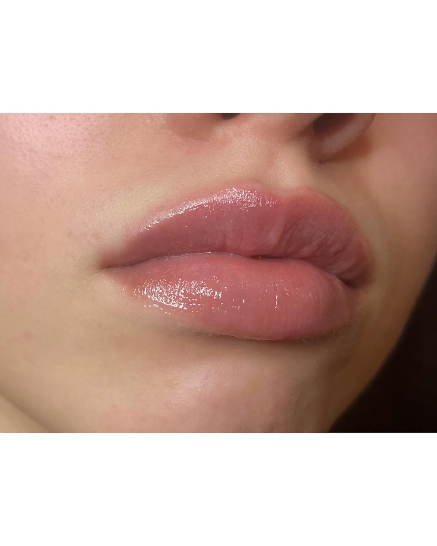 Korekcia asymetrie M shape pier použitím iba 0,6 ml kyseliny hyalurónovej 🫦
• Výsledok po prvej aplikácii 💉
• Efekt : okamžitý
• Trvanie zákroku : 30 minút
• Bolestivosť minimálna, pri každej aplikácii používam anestetický krém, pre Váš maximálny komfort 🙂
• Doba výdržnosti : 6-12 mesiacov. Doba výdrže je vždy orientačná, je veľmi individuálna a je výrazne ovplyvnená životným štýlom klienta.
~ by Dr. Bianca Strenáčiková
info@bianca.sk / dm
+421 918 318 252
#lipaugmentation #zvacseniepier #lipsbybianca #esthetics #aesthetic