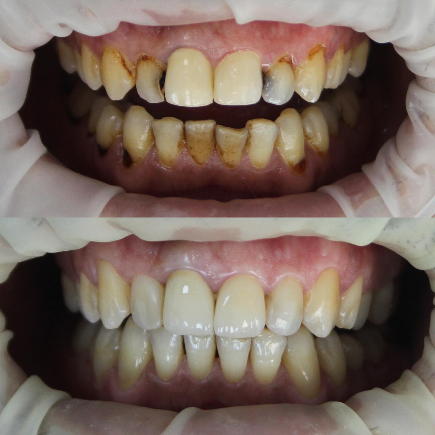 Çürük dişlerin estetik kompozit dolgularla restorasyonu ve eski kaplamaların değişimi ile hastamızın gülüşünde güzel bir fark yarattık :)
Detaylı bilgi ve randevu için kliniğimizi arayabilirsiniz.
📞 05327666377
.
.
.
.
.
.
.
.
.
.
.
.
#izmirdişhekimi #bayraklıdiş
#bornovadiş #bornovadişhekimi #bayraklıdişhekimi #dentalimplants #implant #dişhekimiizmir #izmirdişkliniği #zirkonyumdiş #lamineveneer #kompozitdolgu #kanaltedavisi #zirkonyumkaplama #laminediş #porselenveneer #bleaching #dişbeyazlatma