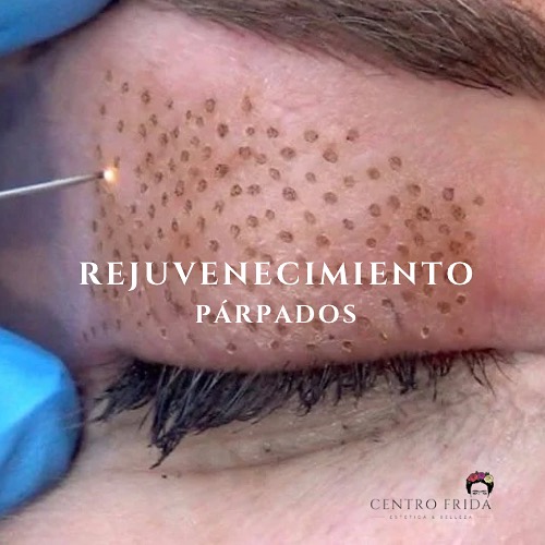 El Plasmapen es una técnica segura y efectiva para tratar de forma no quirúrgica el exceso de piel, arrugas, manchas y xantelasmas entre otros problemas estéticos alrededor de los ojos.
Los beneficios de realizarte este tratamiento son:
💫No invasiva, por lo que está especialmente indicada en personas con exceso de piel en párpados que no quieren someterse a una blefaroplastia quirúrgica.
💫 Evita cambios en la expresión del ojo.
💫 No se limita sólo al párpado sino que también incluye el rejuvenecimiento de toda la zona periocular.
💫 Es confortable ya que se realiza con una técnica anestésica combinanda y que se ajusta al umbral del dolor del paciente.
¿Te gustaría mejorar tus párpados?
Más información y citas 👇🏻
Centro Frida 🌸🌺🌼
Estética & Belleza
Whatsaap 📲624252194
••••••••••••••••••••••••
#plasmapenmadrid #dermapenmadrid #esteticamadrid