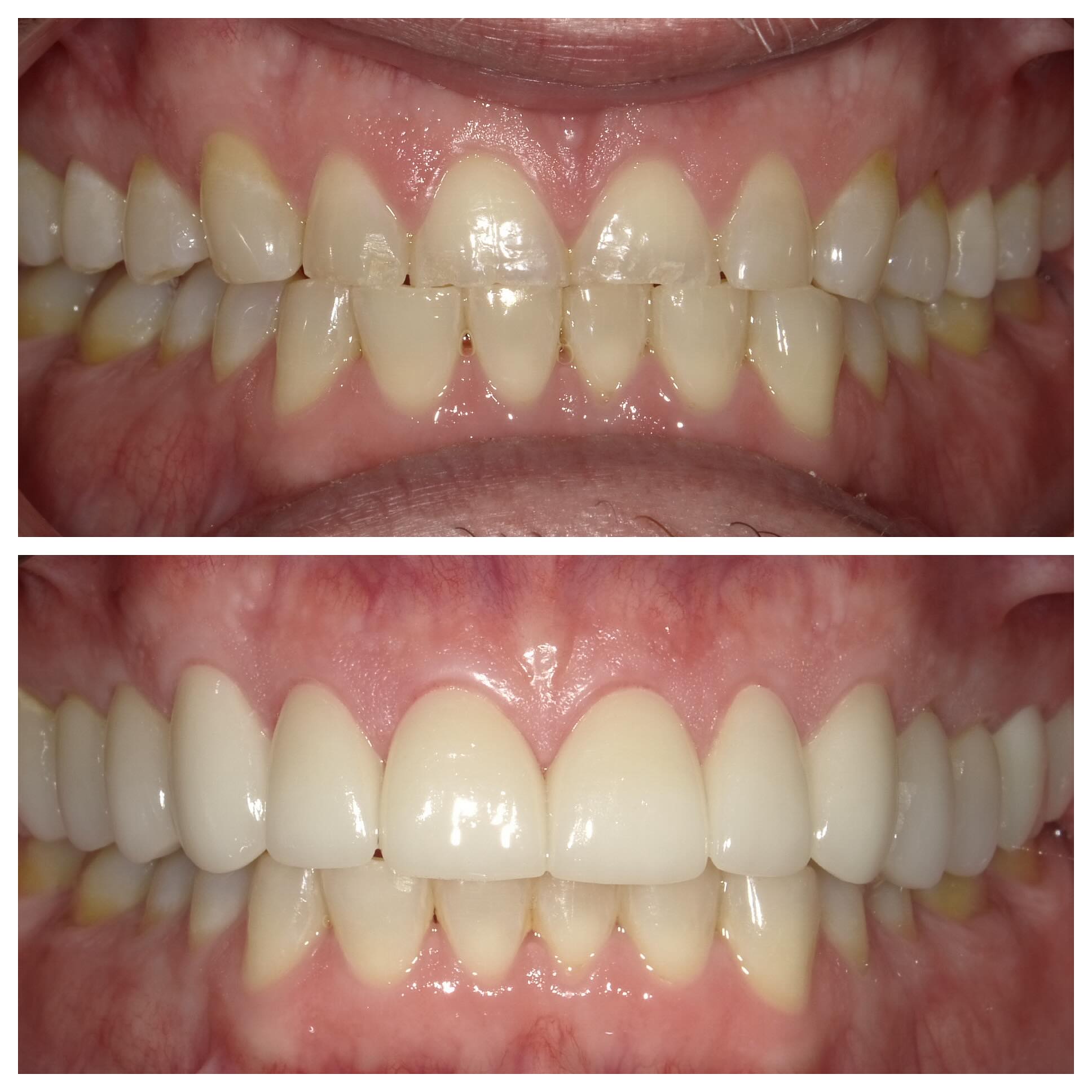 My exceptional patient initially sought veneers for his front teeth, but our treatment plan evolved into a comprehensive full mouth rehabilitation. We took the opportunity to enhance not just his smile but also his bite, aiming for optimal aesthetic and functional outcomes. Initially presenting with an edge-to-edge bite, we decided to increase his vertical dimension of occlusion (VDO), necessitating crowning of all upper teeth and a temporary phase to allow his jaw and supporting muscles to acclimate to the new alignment. This process required considerable patience from my patient. Thanks to the outstanding patients I have the privilege to treat in the DMV area, we successfully completed his treatment within eight weeks, resulting in cementation of his permanent crowns. We are ecstatic with the transformation and results achieved!!!#milliondollarsmile#estheticdentistry#cosmeticdentist#Pahlavanidental#beautifulsmile