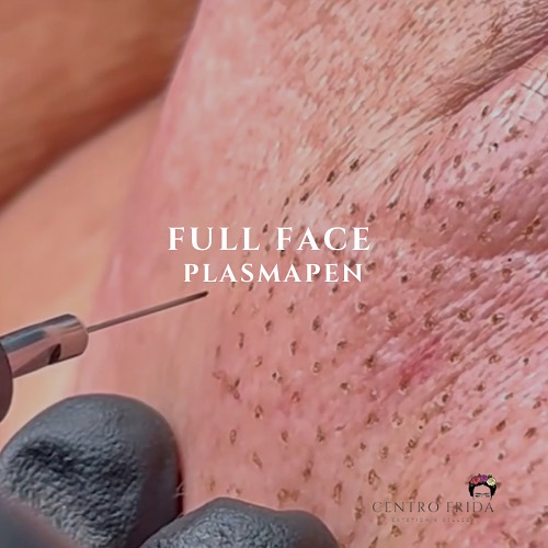 ¿Sabes cómo actúa el plasmapen en tu piel? 👀
El calor emitido hace que la piel se contraiga, dando como resultado una piel más tersa. Además, se estimulan los fibroblastos, que aumentan la producción de colágeno y elastina, dando como resultado una piel tersa, iluminada y suave. ¡Y sin cicatrices!
En Centro Frida somos especialistas en Plasmapen 👌🙌🏻Esta tecnología rejuvenece tu piel por completo.
Escríbenos si quieres más información ℹ️
Centro Frida 🌸🌺🌼
Estética & Belleza
Whatsaap 📲624252194
••••••••••••••••••••••••
#plasmapenmadrid #dermapenmadrid #esteticamadrid