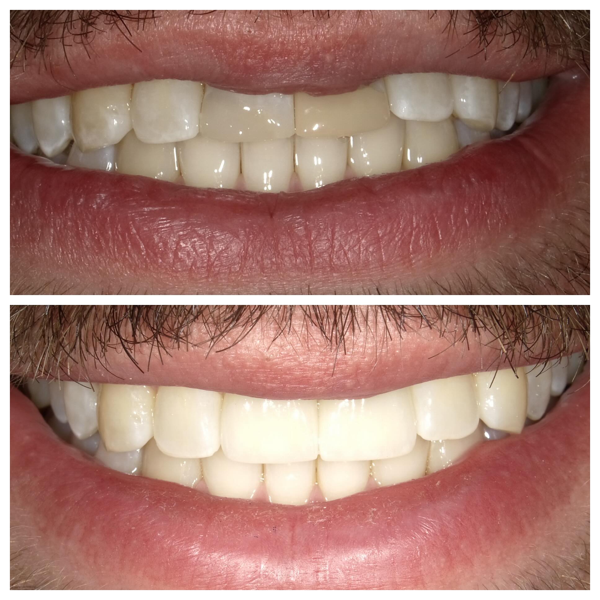 Same patient just different angle! As I mentioned in the last post, patient just finished his Invisalign treatment, we had him bleach for a few weeks and then come in for his crowns! We couldn’t be happier with the results!