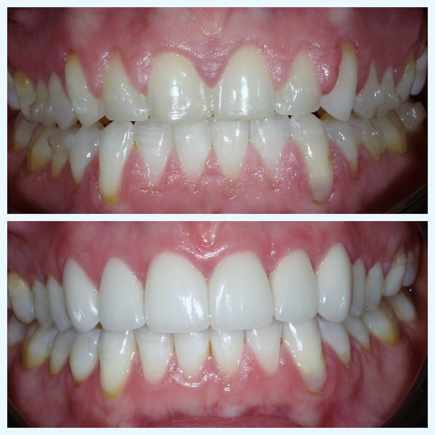 I recently had the honor of treating a beautiful 37-year-old patient who faced significant challenges during her first pregnancy. This difficult experience led to her being on medications that caused gingival hypertrophy.
**Stage 1:** We began with Invisalign to address some minor bite issues and crowding.
**Stage 2:** We performed a laser gingivectomy to reduce the size and thickness of her gum tissue. This was combined with a gingival contouring procedure to enhance the appearance of her teeth, making the crowns look bigger and longer.
After about two weeks of healing, with only minor discomfort during the first few days, we moved to the final stage.
**Stage 3:** We started with cosmetic veneers.
The results were outstanding. The patient expressed that she felt like a new woman, and I couldn’t be happier with the outcome. It’s truly an honor to treat such a wonderful patient and help her feel good about herself again. She’s beautiful both inside and out, and this transformation has only highlighted her natural beauty.
#cosmeticdentistry#cosmeticveneers#facialesthetics#iloveteeth#dcdentist#uscdentist#pahlavanidental#veneers#aestheticdentist