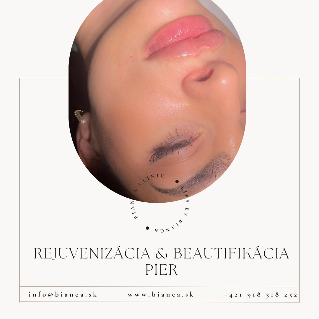 Rejuvenizácia (omladenie), hydratácia a beautifikácia pier patria medzi naše najžiadanejšie zákroky. 🫦🤍
Vždy však musíme vychádzať z tvaru našich vlastných pier, ktoré nám boli dané od prírody. ☝🏼
Pri dosahovaní krásnych prirodzených a plných pier sa netreba nikam ponáhľať.
Pokiaľ chceme dosiahnuť prirodzené, hydratované zmyselné alebo decentné pery, pri úzkom alebo M shape type pier budeme potrebovať aspoň dva ošetrenia, pričom použijeme špeciálnu techniku aplikácie a prípadnú kombináciu kyseliny hyalurónovej s botulotoxínom. 💉💋
Nezabúdajte - aplikácia výplňových materiálov a botulotoxínu patrí iba do rúk lekára ☝🏼
•
Foto : naša ďalšia krásna klientka po aplikácii 1ml kyseliny hyalurónovej po 2. ošetrení
~ by dr. Bianca Strenáčiková
#lipsaugmentation #aesthetic #lipsbybianca #estheticmedicine#lipfiller