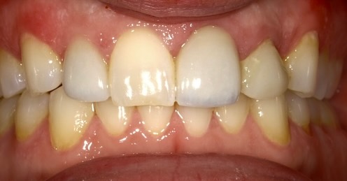 Checkout this case by our Dr. Troy! Patients chief complaint was mismatched shape and shade!
Schedule your next appointment at
pahlavani dental.com
#dentistryworld #estheticdentistry #dentist #dental #esthetics #veneers #pahlavani #dentistry #slay