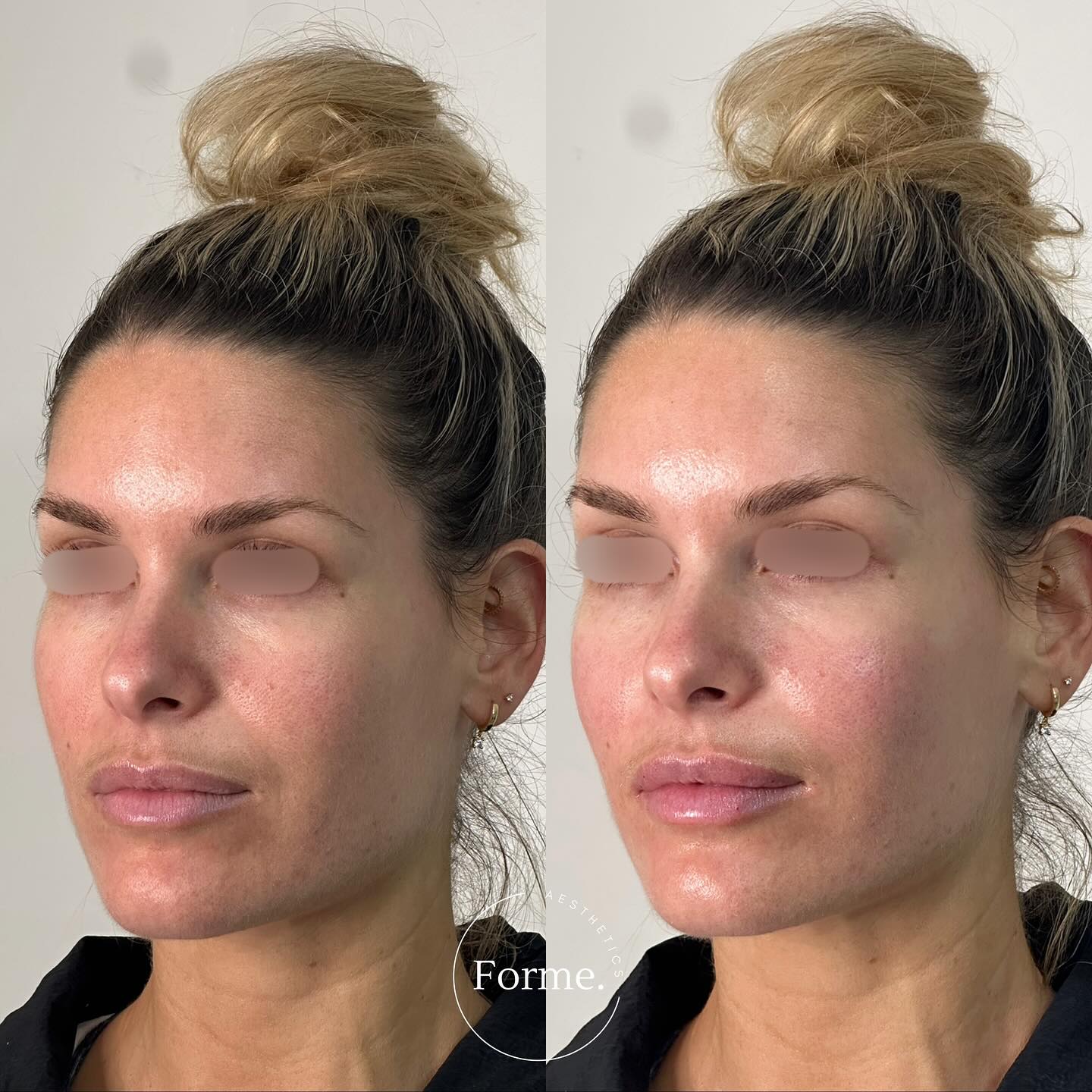 As we journey through our 30s, we begin to show subtle signs of aging, with mid-face volume loss being one of the most common changes. This can lead to a slight hollowing under the eyes, flatter cheeks, and the start of smile lines.
At Forme Aesthetics, we offer consultations to address volume changes due to ageing.
Any surgical or invasive procedure carries risks. Before proceeding, you should seek
a second opinion from an appropriately qualified health practitioner. Results vary.
Consent is always obtained before sharing patient images.
Treatment performed by Stephanie Sirillas RN