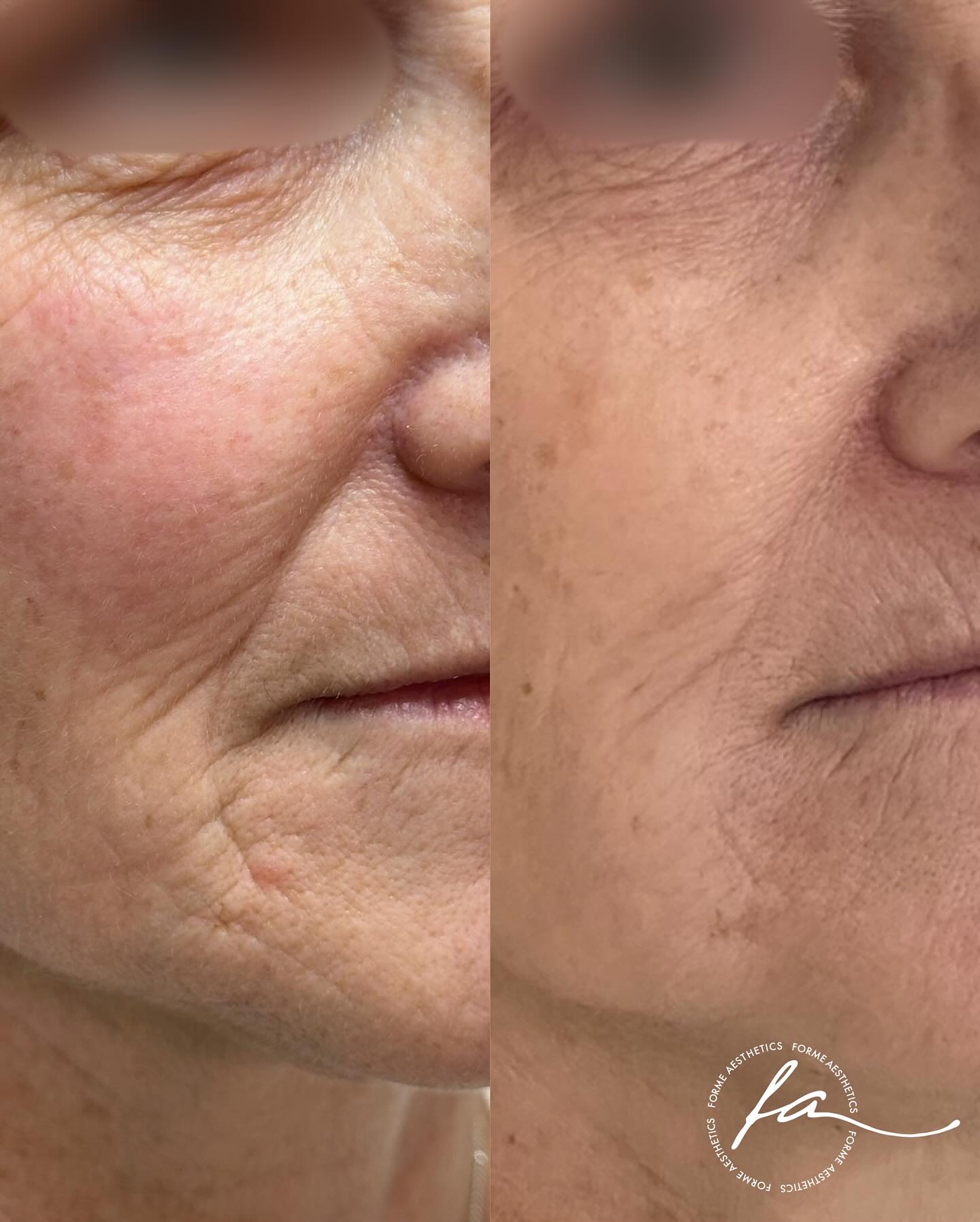 A multi modality approach to softening facial lines.
Due to TGA requirements, we can only mention TIXEL being one of the modalities used. Otherwise we are happy to discuss a full treatment plan during a consultation.
Tixel is an innovative skin rejuvenation treatment that uses thermo-mechanical energy to improve skin texture, reduce fine lines, and boost collagen production. It’s non-invasive with minimal downtime, perfect for achieving smoother, brighter, and youthful skin.
Any surgical or invasive procedure carries risks. Before proceeding, you should seek
a second opinion from an appropriately qualified health practitioner. Results vary.
Consent is always obtained before sharing patient images.
Treatment performed by Stephanie Sirillas RN
