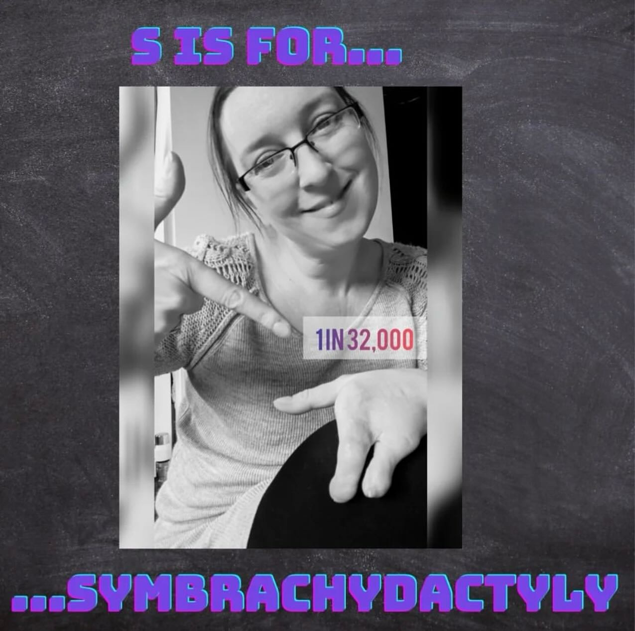 “Symbrachydactyly......my upper limb difference.
I didn’t actually work out the official name of my upper limb difference until 2 years ago, when I saw a post by @beautifullymade_community and read the description of Sym and realized that this was what I had been born with. My parents were not ever given an “official” name for my upper limb difference. I was born with Fibular Hemimelia too, but that was easier to diagnose because a simple X-ray revealed the total absence of a fibula!!!
I have had 3 lots of surgery (I think!) on my left hand since birth. The first two were to separate out the bulky section of my hand into two fingers. They were able to do this because each “finger” contained a sufficient enough bone structure to be able to do so. I have movement in 2 joints of my middle finger but only minimal movement in 1 joint of my little finger. Both of these surgeries took place at @greatormondst when I was not even a year old! I then had a 3rd surgery in this hand when I was about 10 to attempt to straighten the bone through the joint by use of a metal pin......this did work for that joint, but a few years later, another joint became bent. It has never bothered me that much in adult life to have any further surgery.
I may not have 5 fingers, nowhere near......and they don’t all bend at all joints......not even close! BUT, my little sym hand can still do lots of things. Here are a few standouts:
🔸Can grip the steering wheel so I’m able to drive an unadapted car
🔸Can hold a 2 pint of milk with my one slightly bent finger!
🔸Can hold a glass of wine.....and not spill it 🤣
🔸Can manicure my right hand (and quite well if I don’t say do myself!! Years of practice!!)
🔸Can hold hands with my boys.....although they all say they prefer the other one!! “
#repost from @mumof3andamputee 🤍🤍🤍
.
.
#limbdifference #limbdifferenceawareness #llldam #llldam2024 #symbrachydactyly #limbdifferenceawarenessmonth #beautiful #beautifullymade #inclusiveeducation #limbdifferencespotlight