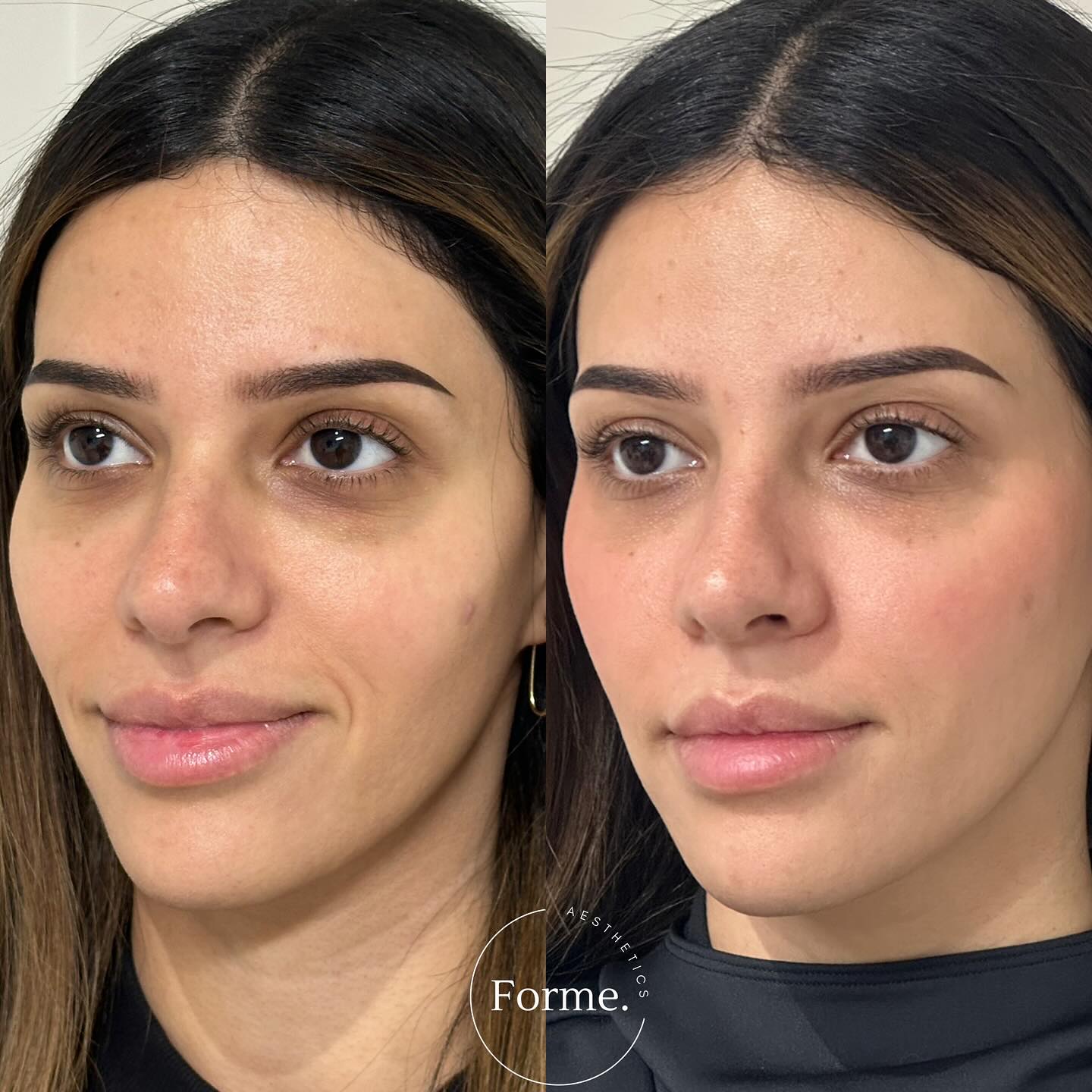 Volume replacement and light reflex improvements.
Before and 3 weeks after treatment.
Any surgical or invasive procedure carries risks. Before proceeding, you should seek
a second opinion from an appropriately qualified health practitioner. Results vary.
Consent is always obtained before sharing patient images.
Treatment performed by Stephanie Sirillas RN