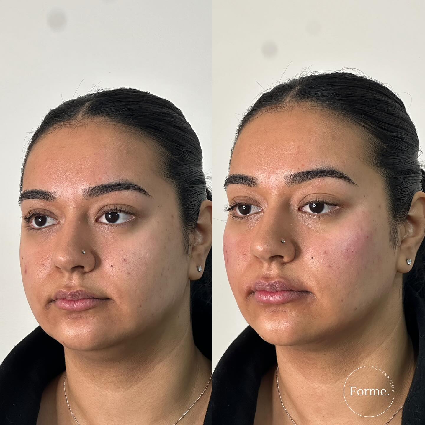 We provide consultations about definition and volume replacement.
Any surgical or invasive procedure carries risks. Before proceeding, you should seek
a second opinion from an appropriately qualified health practitioner. Results vary.
Consent is always obtained before sharing patient images.
Treatment performed by Stephanie Sirillas RN