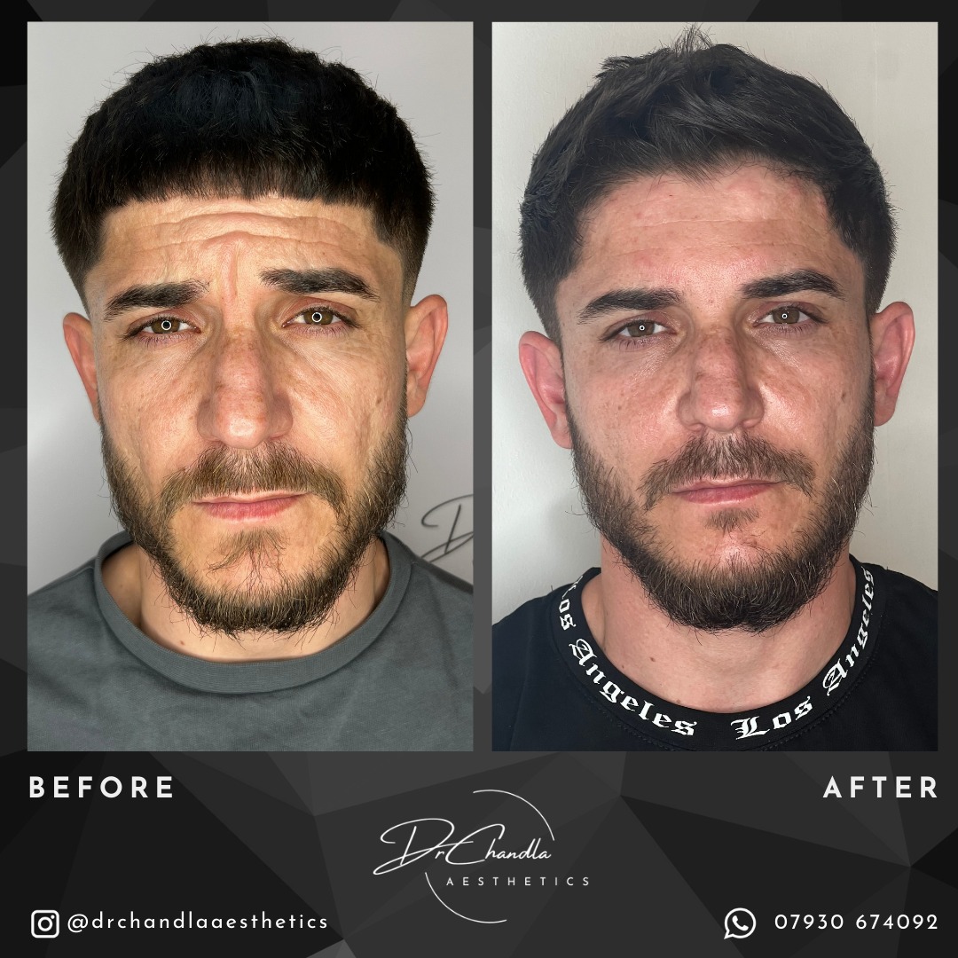 See the Difference Aesthetics Can Make.
This gentleman came in asking for a refresh of his face before a holiday. These photos are taken 2 weeks apart, allowing the swelling to settle and for his anti-wrinkle treatment to take effect.
He was treated with 3 x Areas Anti-wrinkle injections treating his forehead, frown lines and crow's feet. He has also had 1 ml of filler restoring volume to his cheeks and nasolabial folds.
Get in touch for your bespoke treatment plan and to begin your aesthetics journey.
Dr Chandla Aesthetics is a Doctor Led Medical Aesthetics Clinic.
WhatsApp: 07930674092
Email: info@drchandlaaesthetics.co.uk
www.drchandlaaesthetics.co.uk
