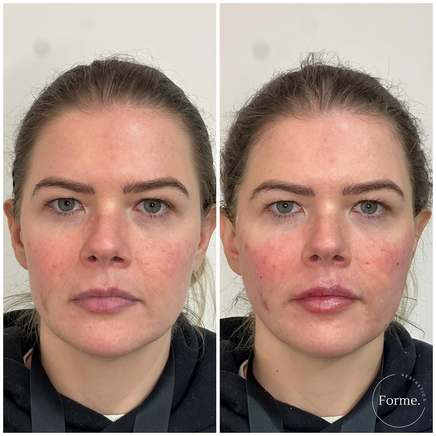 𝚃𝚑𝚛𝚎𝚊𝚍 𝚕𝚒𝚏𝚝 / 𝚝𝚒𝚜𝚜𝚞𝚎 𝚛𝚎𝚙𝚘𝚜𝚒𝚝𝚒𝚘𝚗𝚒𝚗𝚐
Note softening of heaviness to jaw, buccal fat & nasolabial folds. There is also improved cheek contour.
Given the patients age, results are subtle and soft. Threads allow us to contour the face without adding volume unnecessarily.
Any surgical or invasive procedure carries risks. Before proceeding, you should seek
a second opinion from an appropriately qualified health practitioner. Results vary.
Consent is always obtained before sharing patient images.
Treatment performed by Stephanie Sirillas RN