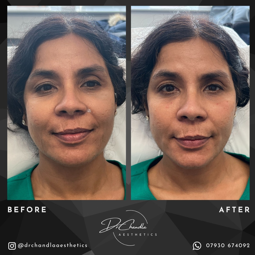 Say goodbye to tired eyes.
This model wanted to treat the ter troughs she had developing on the right side. This was treated with Definisse Touch in the tear trough with a needle, with a small amount of filler also placed on the left. She also had a small amount of Definisse Core placed under her mouth to treat her developing Marionette Lines.
Experience the difference for yourself. Contact Dr Chandla Aesthetics for a consultation or book a consultation today.
Dr Chandla Aesthetics is a Doctor Led Medical Aesthetics Clinic.
WhatsApp: 07930674092
Email: info@drchandlaaesthetics.co.uk
www.drchandlaaesthetics.co.uk
#teartroughfillers #teartroughfillerbirmingham #teartroughfillersolihull #teartroughfillerwestbrom #aesthetics #aestheticsdoctor #aestheticsdoctorbirmingham #aestheticsdoctorsolihull #aestheticsdoctorwestbromwich