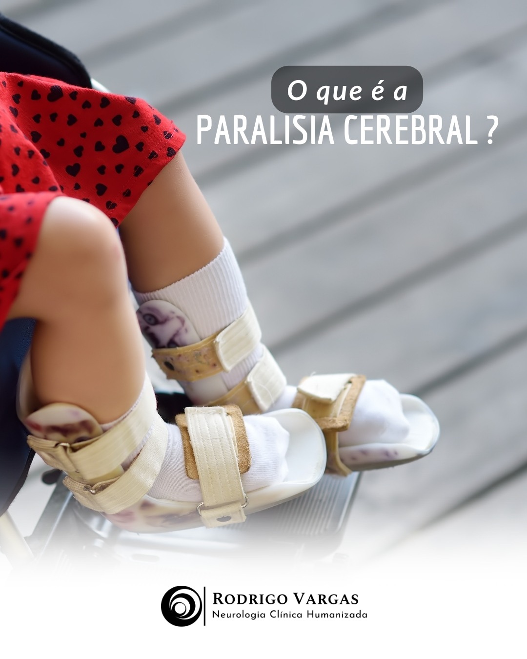 O que é a paralisia cerebral?
A paralisia cerebral (PC) é um grupo de condições neurológicas permanentes que afetam o movimento, a postura e a coordenação motora. Ela é causada por danos ao cérebro em desenvolvimento, geralmente durante a gravidez, o parto ou nos primeiros meses de vida. As causas podem incluir falta de oxigênio ao nascimento, infecções maternas, acidentes vasculares cerebrais fetais, entre outros fatores.
A PC não é uma doença progressiva, ou seja, os danos cerebrais não pioram com o tempo. No entanto, as complicações associadas, como contraturas musculares e problemas ortopédicos, podem se agravar sem o tratamento adequado. Os sintomas variam amplamente, dependendo da gravidade e da área do cérebro afetada. Podem incluir dificuldade em andar, falar, segurar objetos, espasticidade (rigidez muscular), movimentos descoordenados ou descontrolados e dificuldades de equilíbrio.
Além disso, muitas pessoas com paralisia cerebral apresentam condições associadas, como distúrbios visuais, auditivos, intelectuais ou epilepsia. O diagnóstico é feito através de avaliações clínicas e exames de imagem, como tomografia ou ressonância magnética.
Embora não exista cura para a paralisia cerebral, tratamentos como fisioterapia, terapia ocupacional, medicamentos e, em alguns casos, cirurgia, ajudam a melhorar a qualidade de vida e a funcionalidade dos pacientes.
Dr. Rodrigo R. N. Vargas
Médico Neurologista e Neuropediatra
Título de Especialista em Neurologia pela Academia Brasileira de Neurologia (ABN/AMB)
Título de Especilista em Neuropediatria pela Sociedade Brasileira de Pediatria e Academia Brasileira de Neurologia (SBP/ABN/AMB)
Membro Titular da Academia Brasileira de Neurologia (ABN)
Membro Titular da Sociedade Brasileira de Neurologia Infantil (SBNI)
CRM-GO 15286 / RQE 9716 / RQE 18012
#InclusãoSemLimites
#ConscientizaçãoPC
#SuperaçãoDiária
#PCnãoDefine
#PaisAtentos
#Neuropediatria
#OesteGoiano
#rodrigovargasneuro
#HospitalSãoPaulo